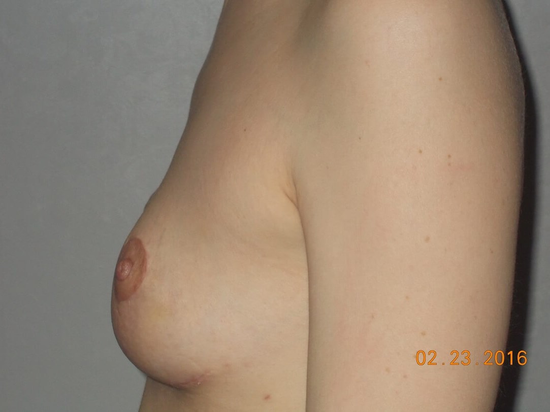 Side View After