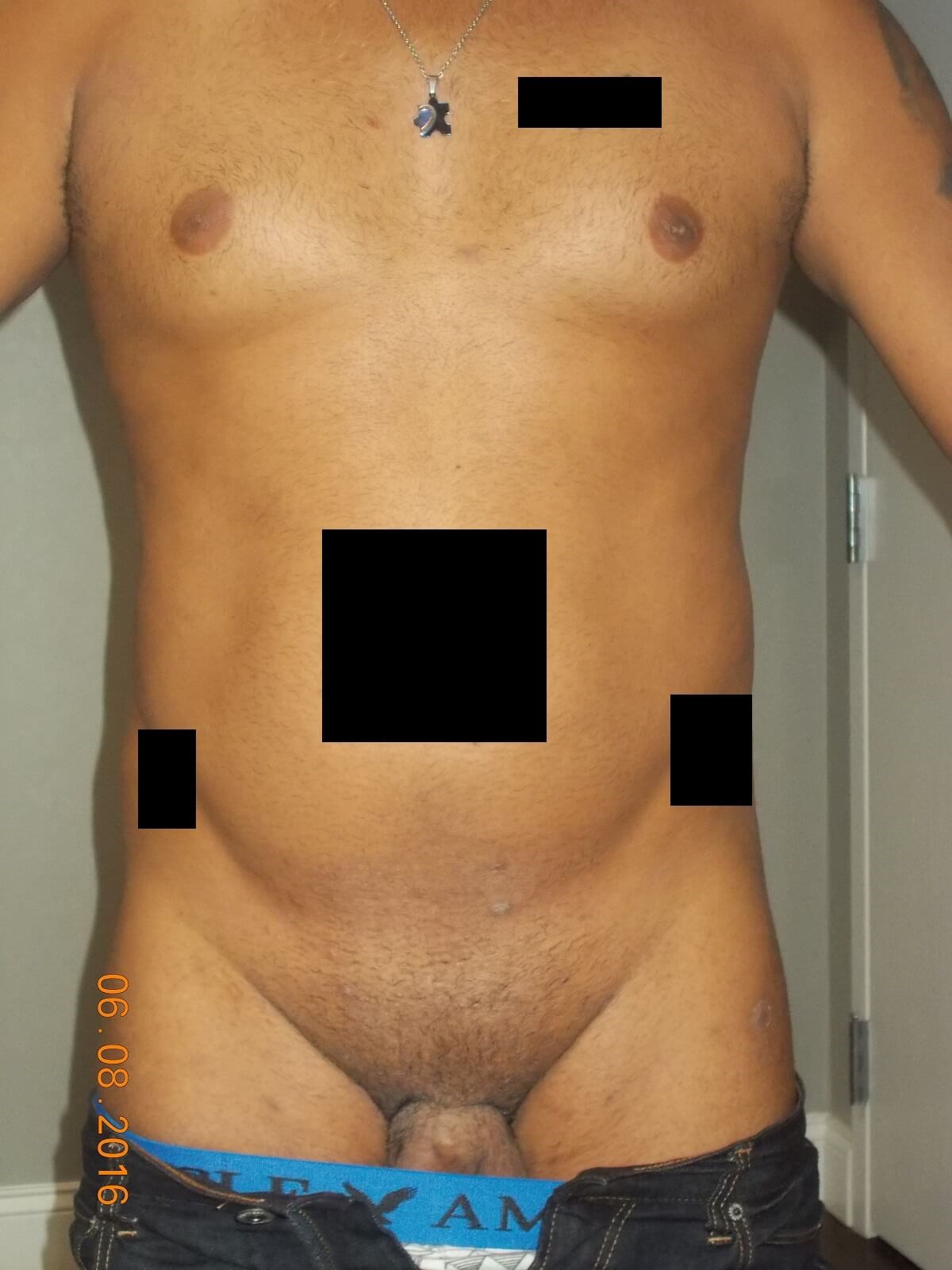 Front View Before