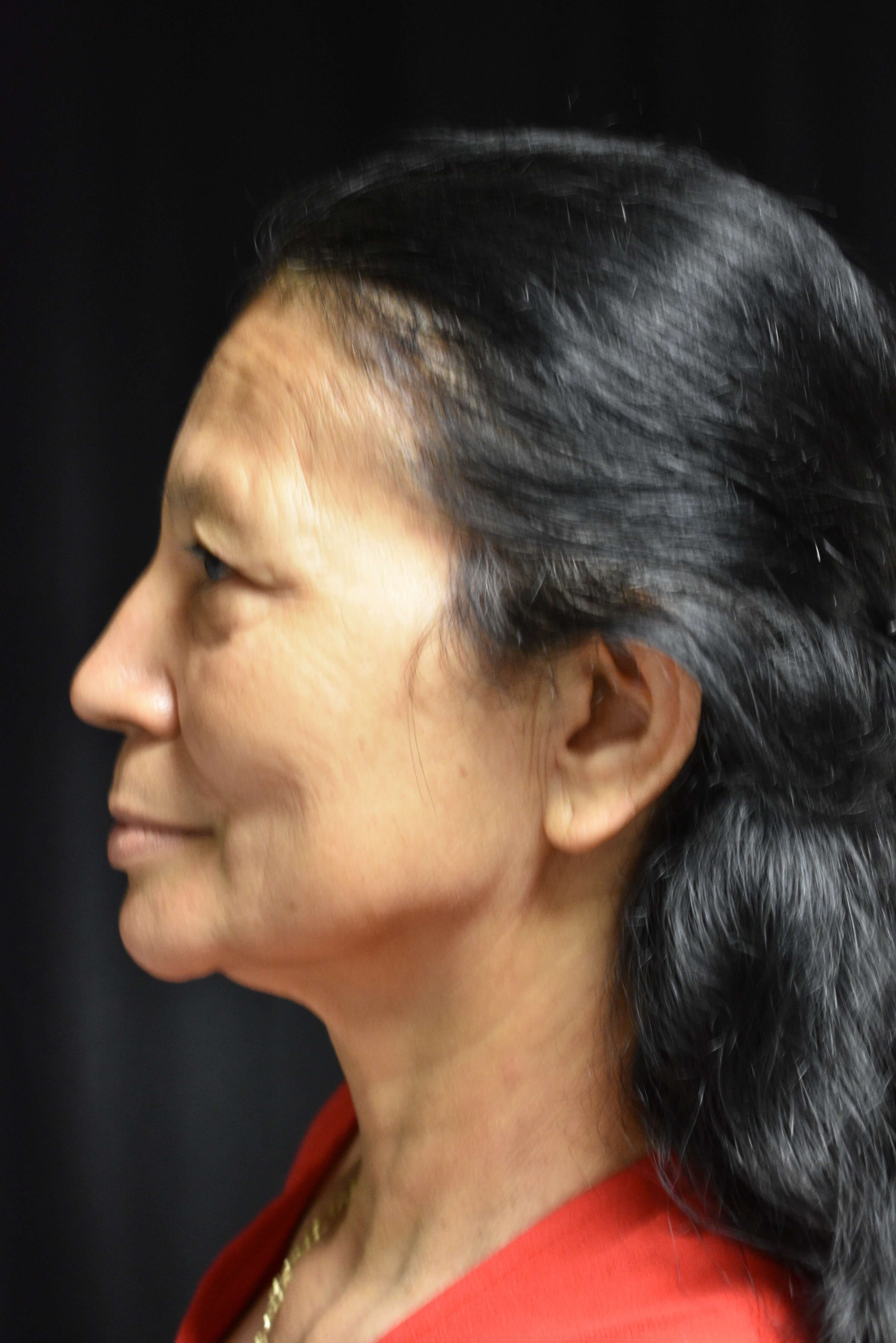 Left side View Before Face and eye lift