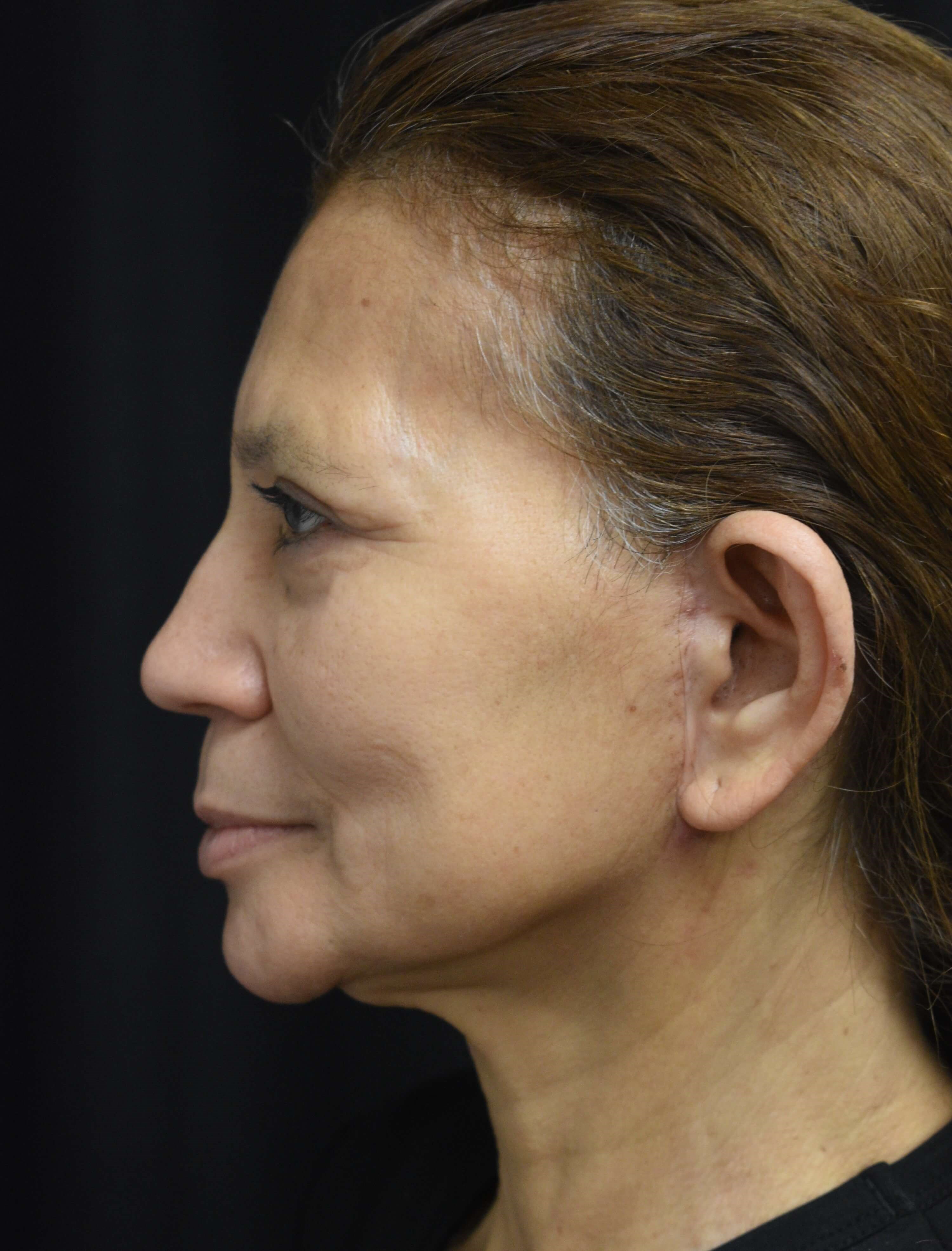 Left side View After face and eyelift