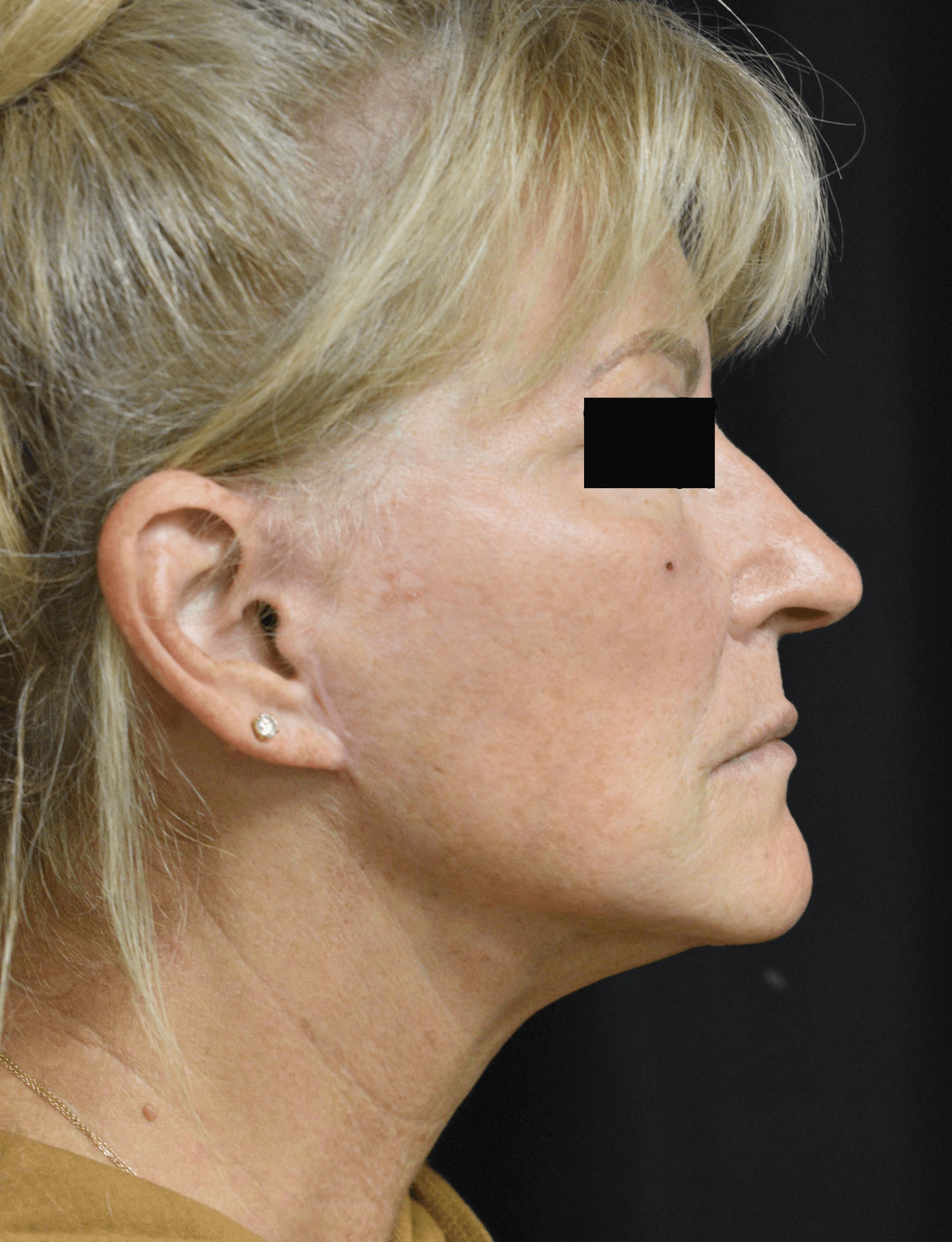 Facelift Right side After DEEP PLANE Face lift