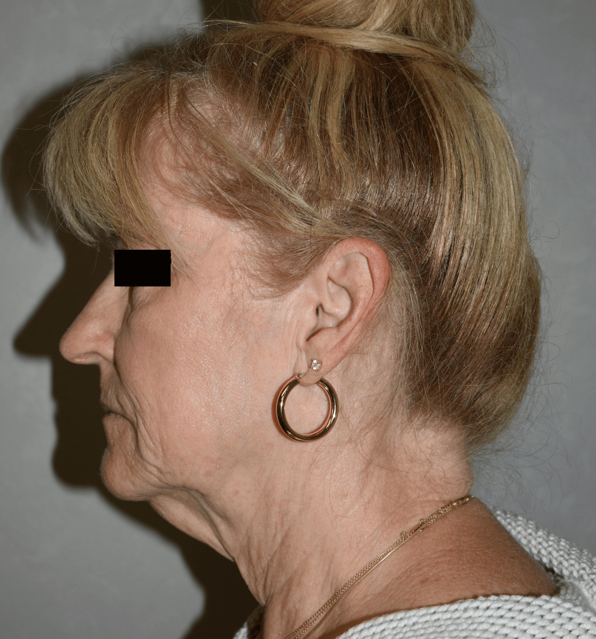 Facelift Left side Before Face lift
