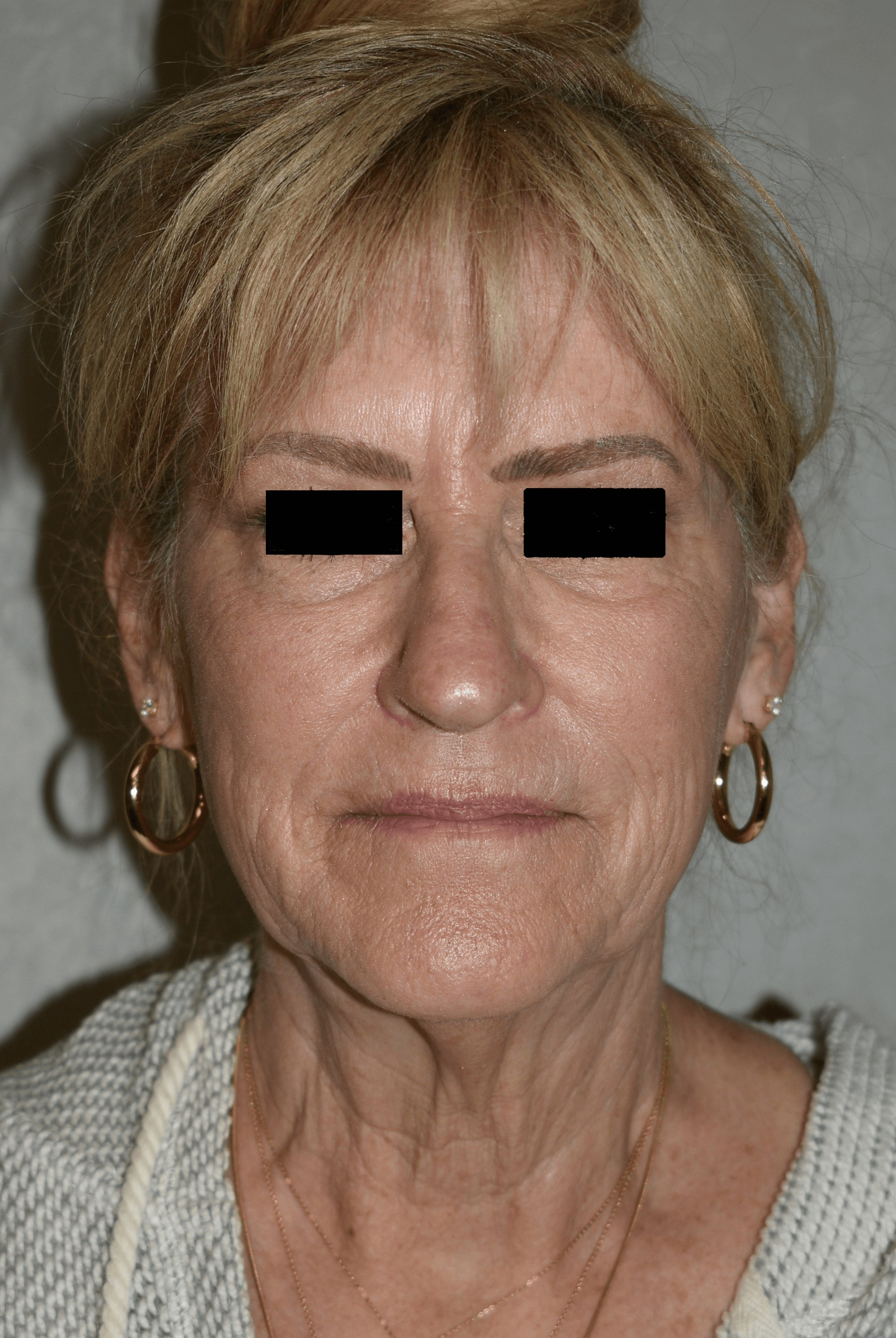 Facelift Front View Before Face lift