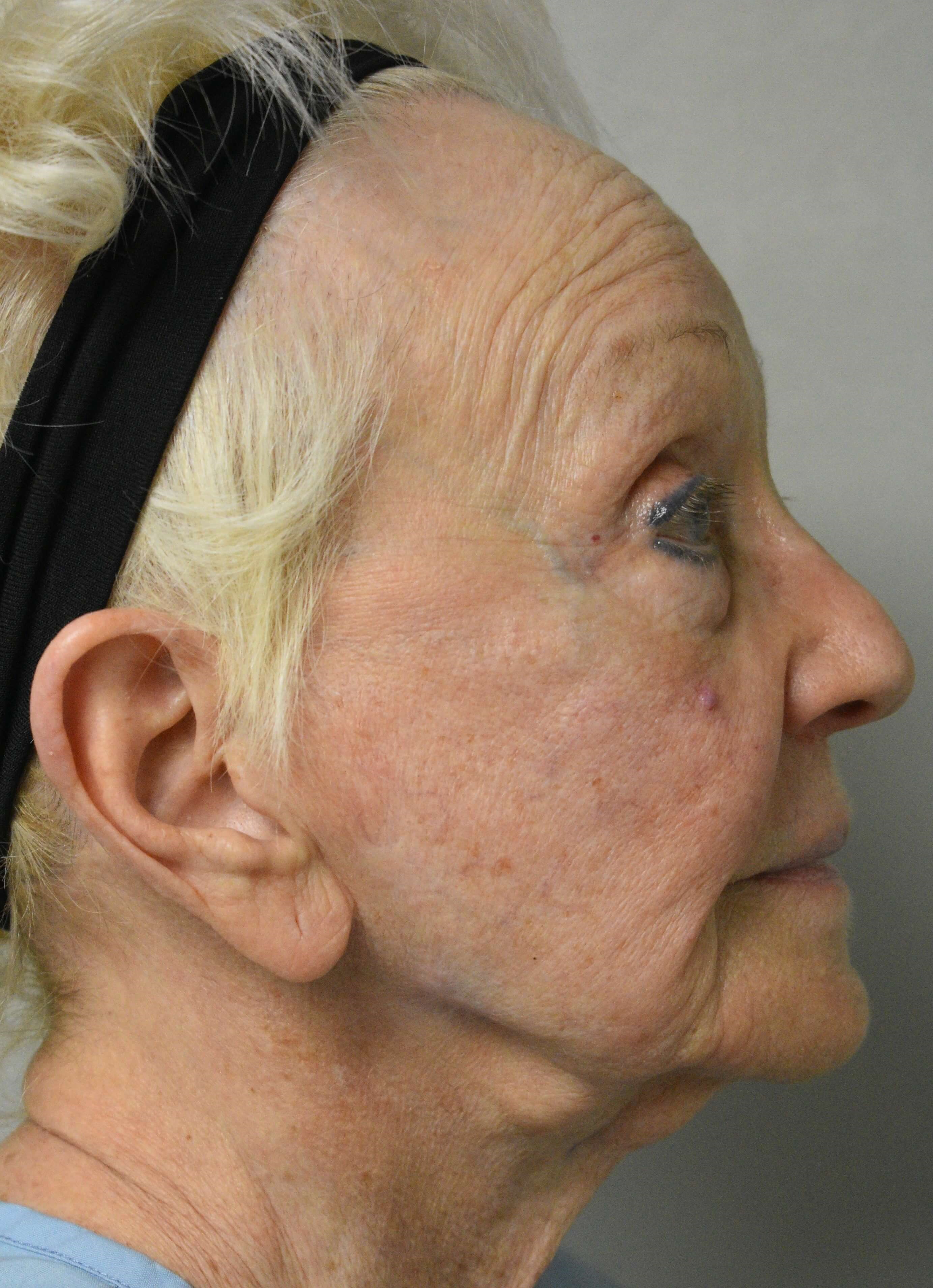 Facelift Before and After Before Face lift