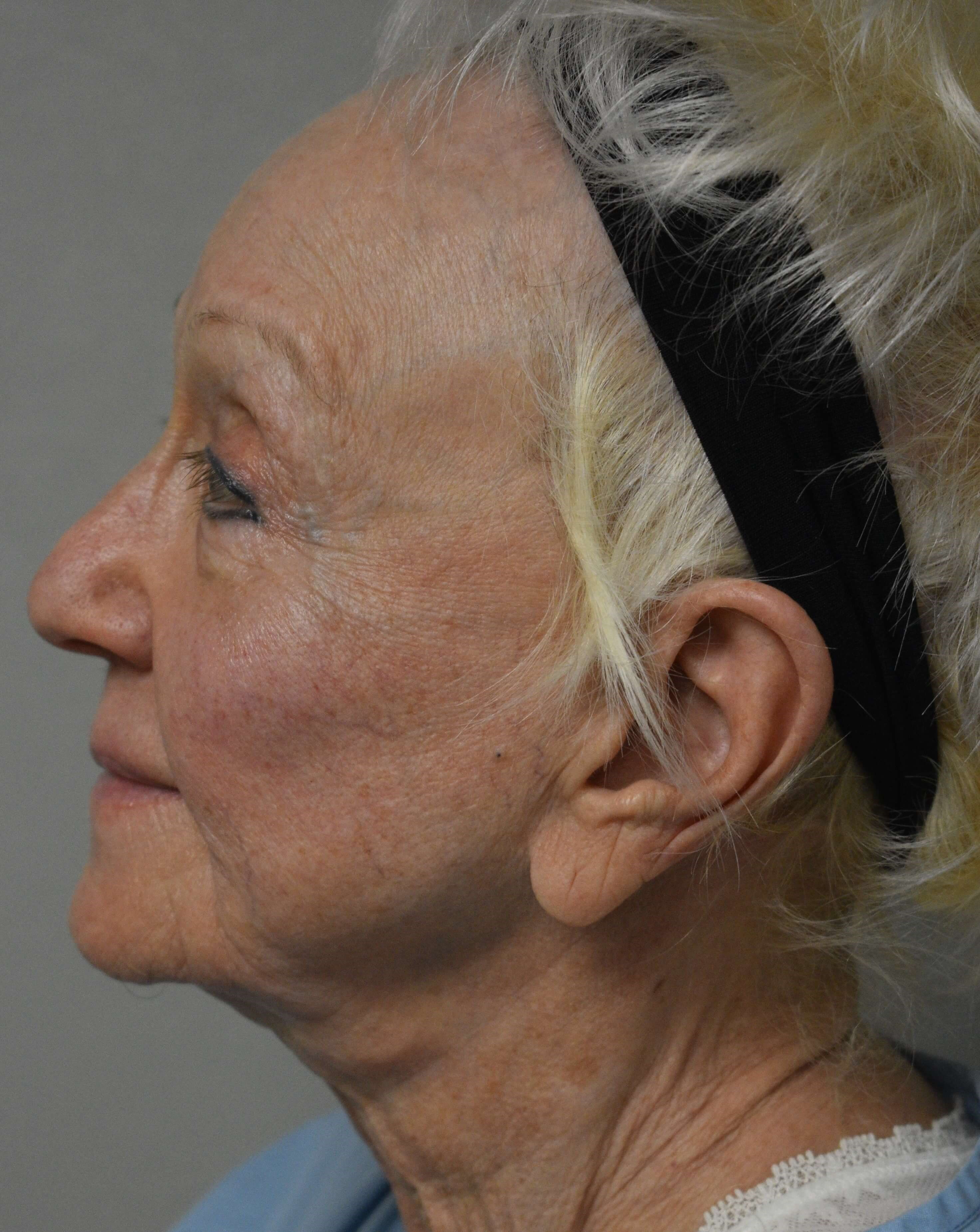 Facelift Before and After Before Face lift