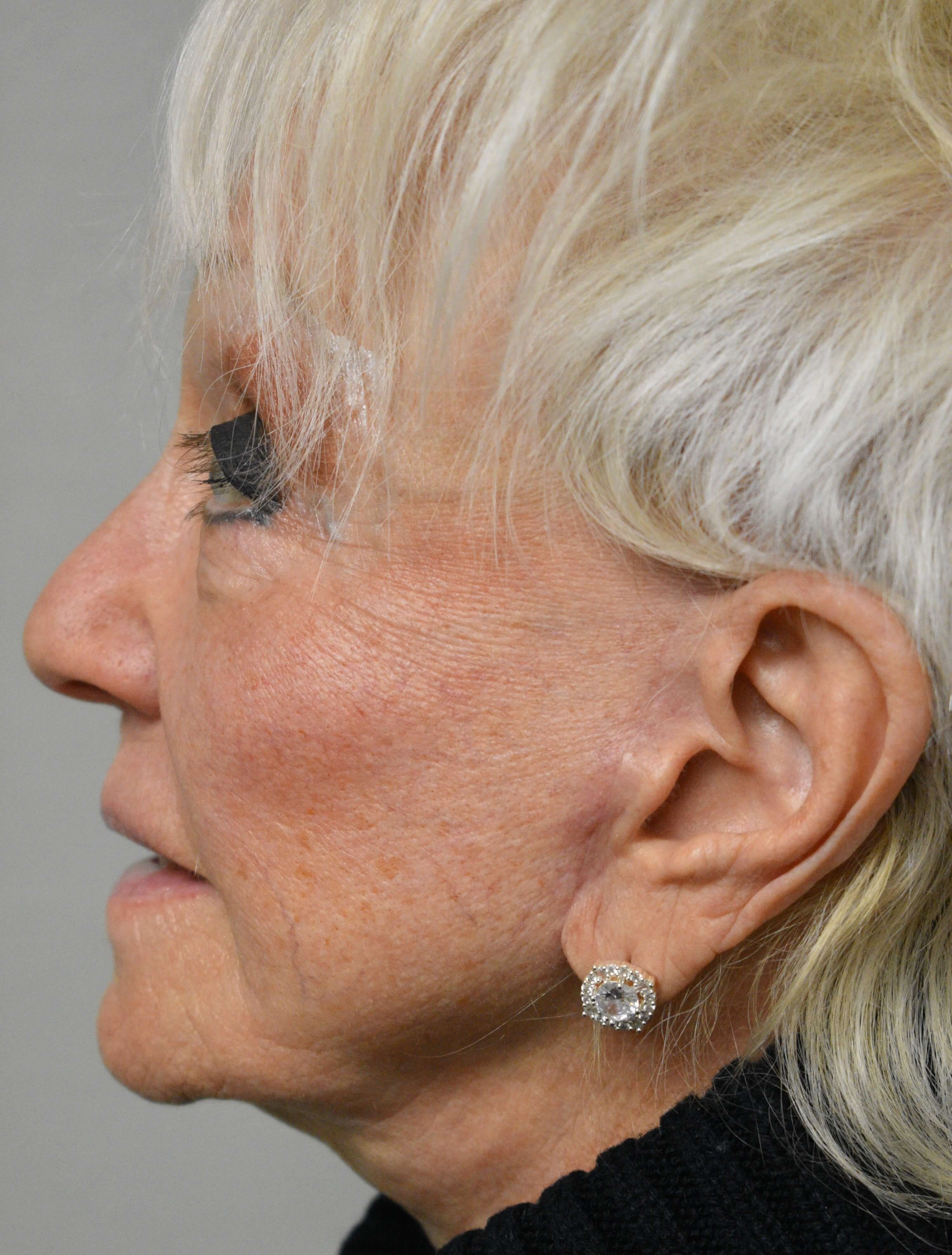 Facelift Before and After After Face lift