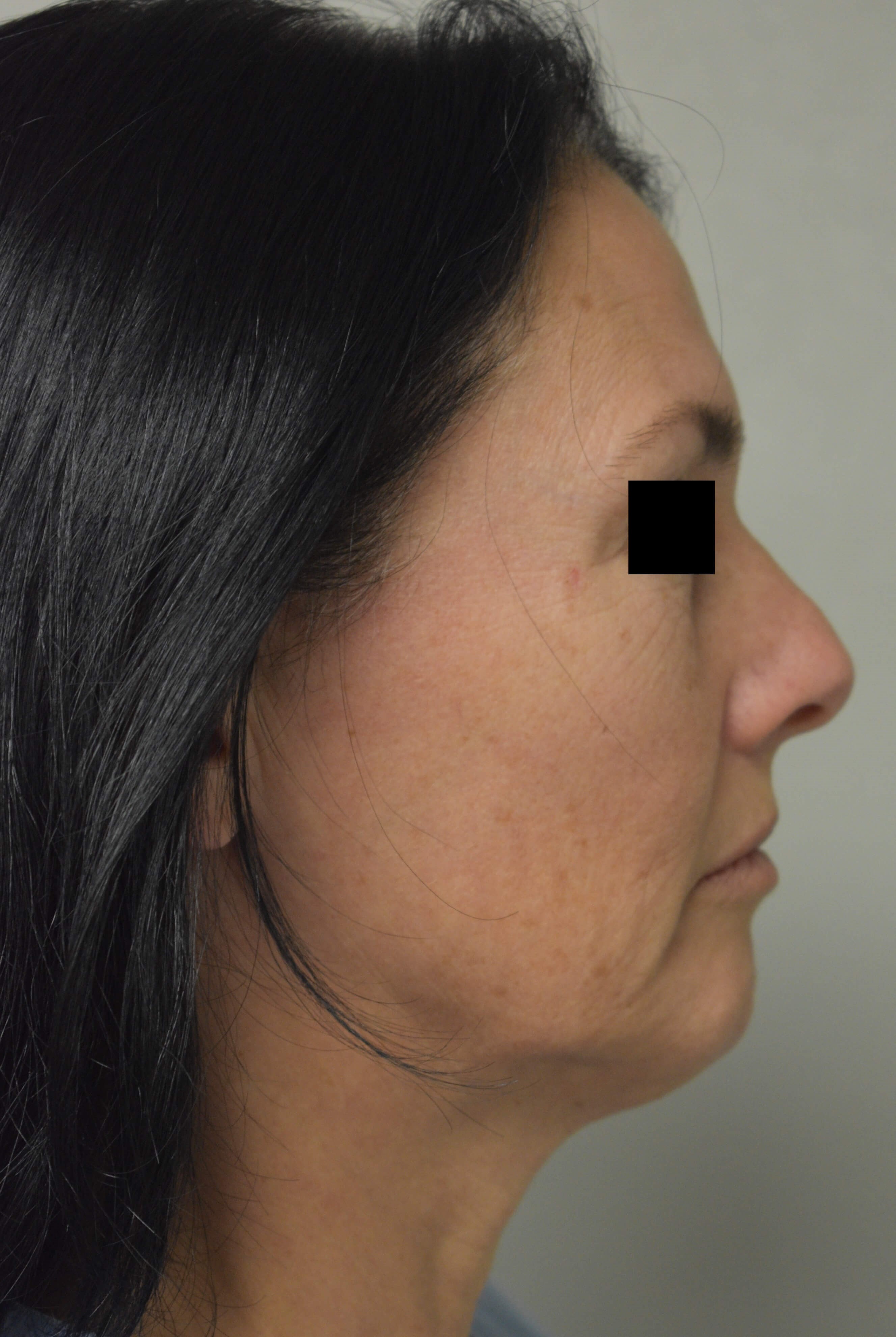 Facelift Before and After Before