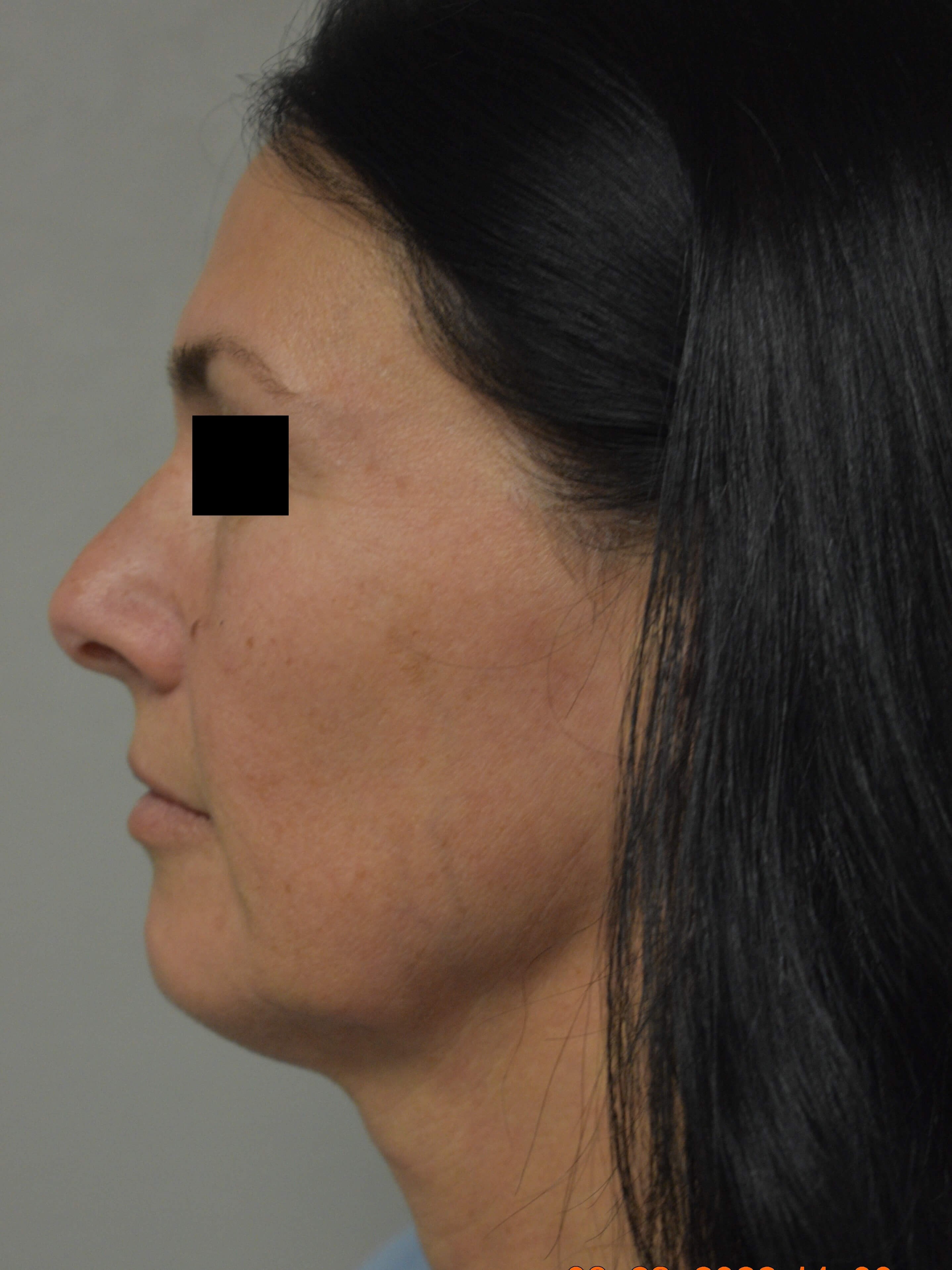 Partial Facelift {Mini} Before