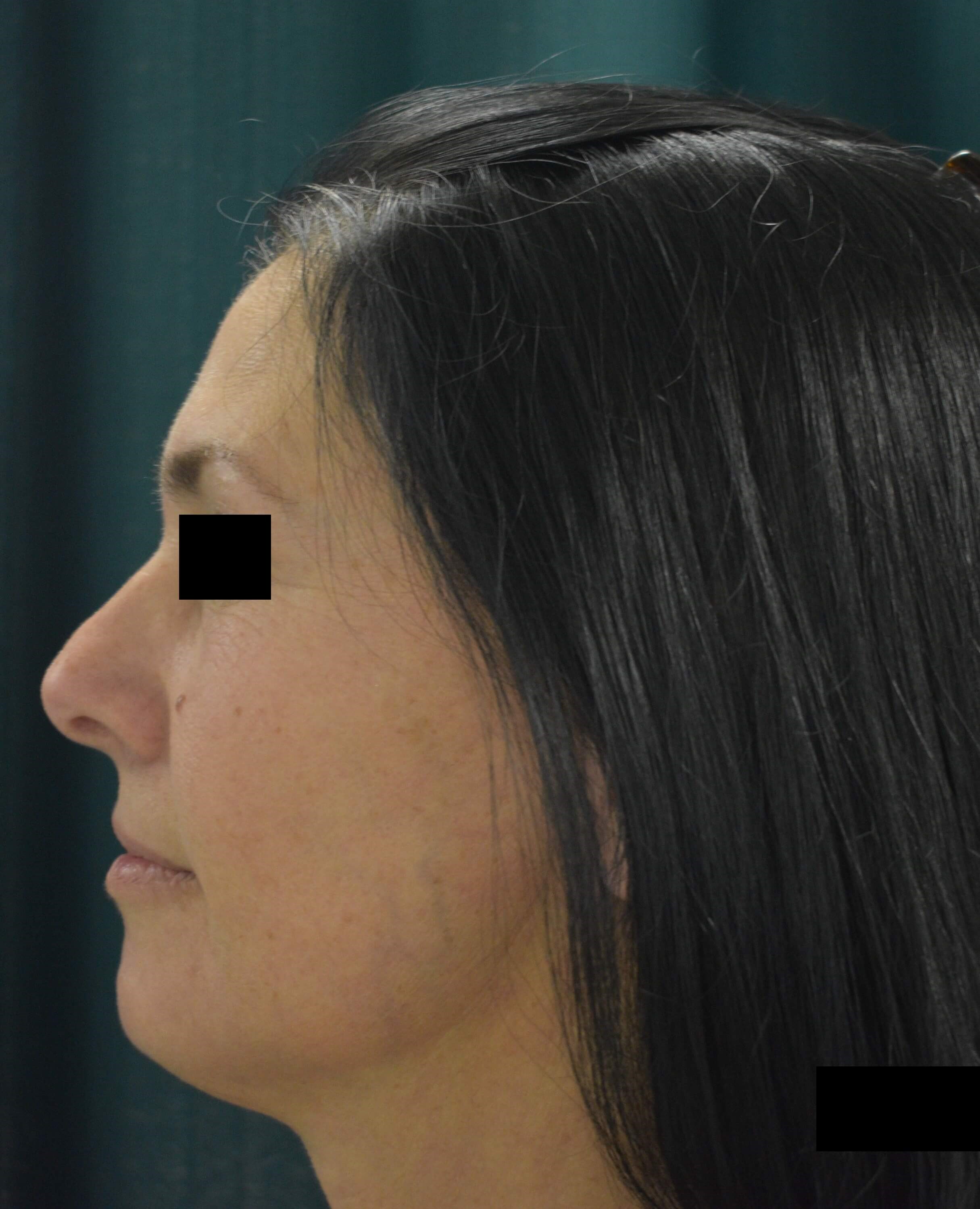 Partial Facelift {Mini} After