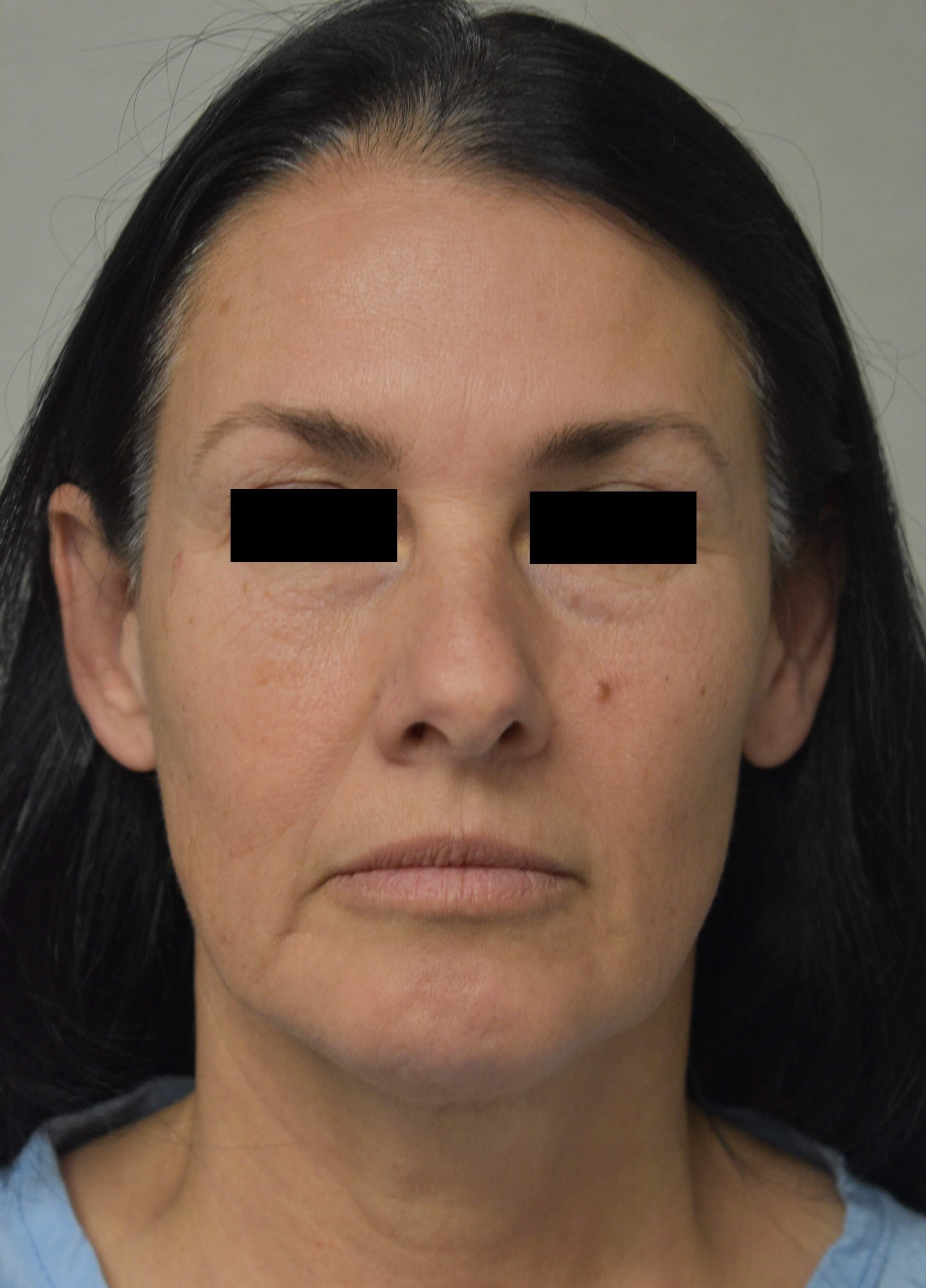 Partial Facelift Front Before