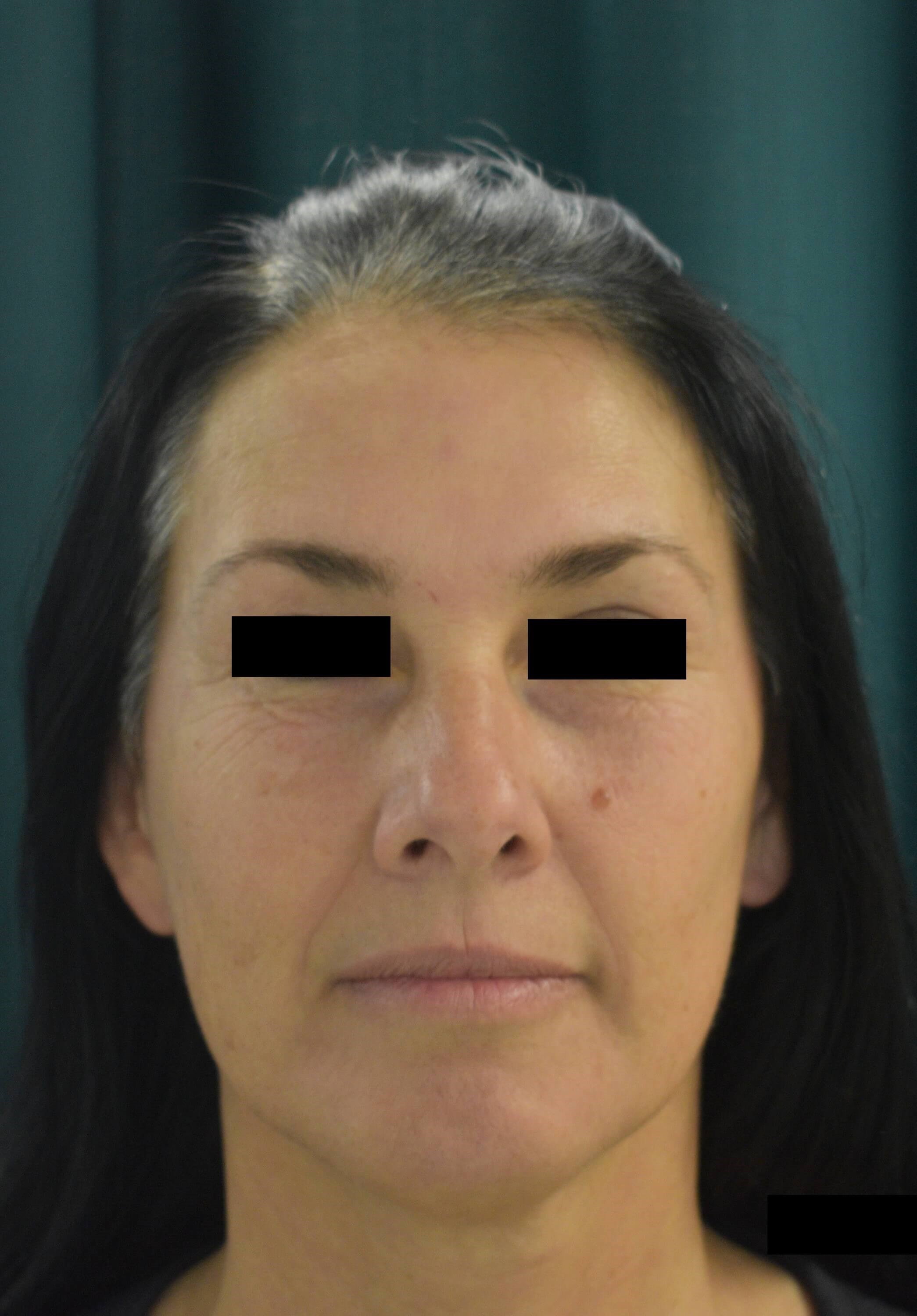 Partial Facelift Front After
