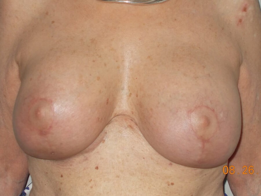 Front View After