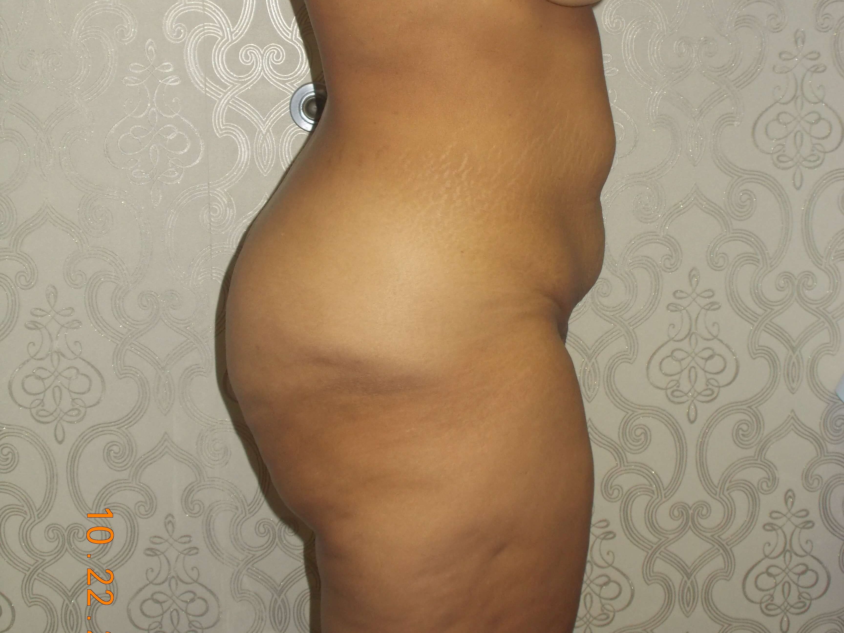 Side View Before
