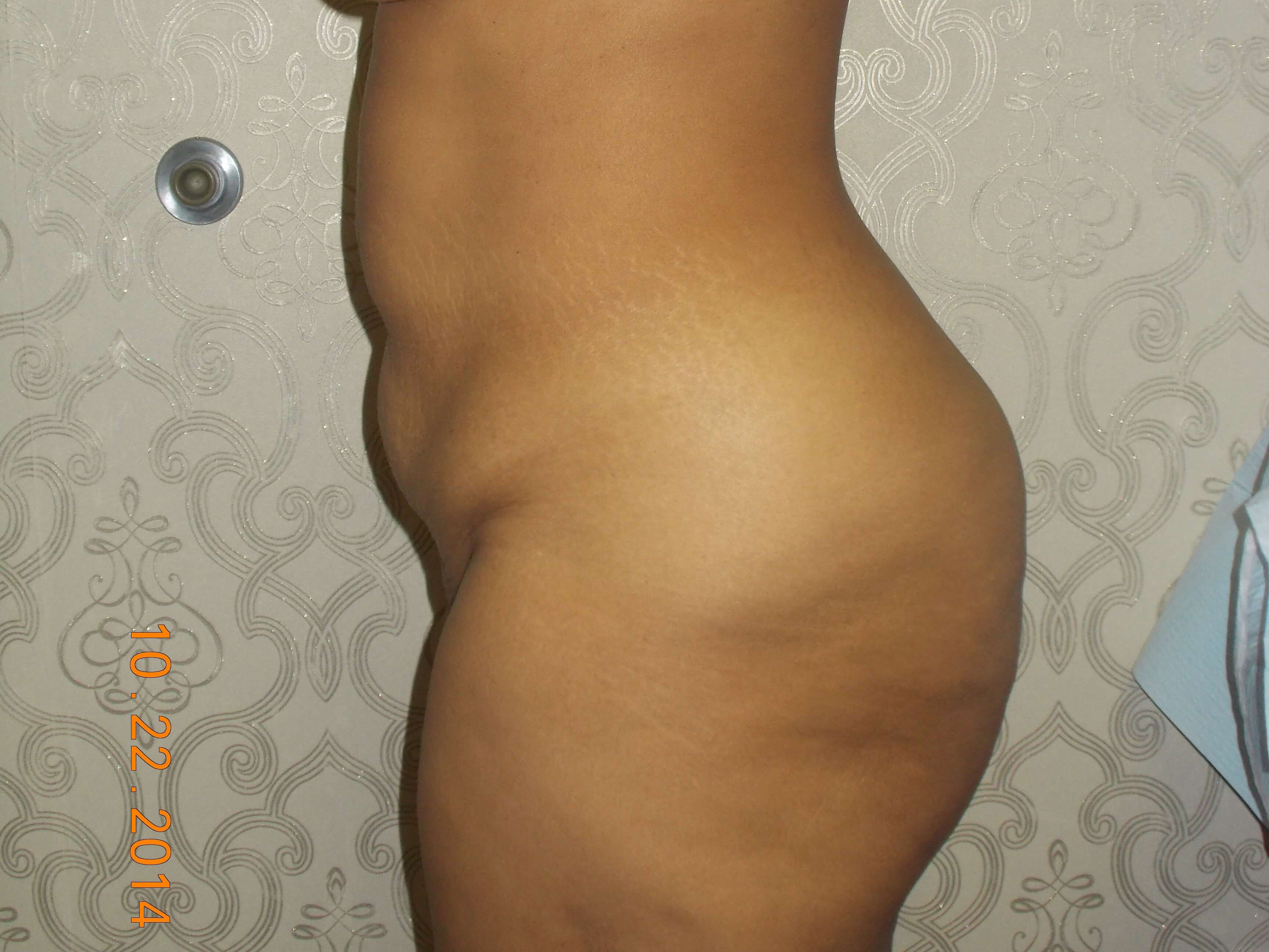 Side View Before