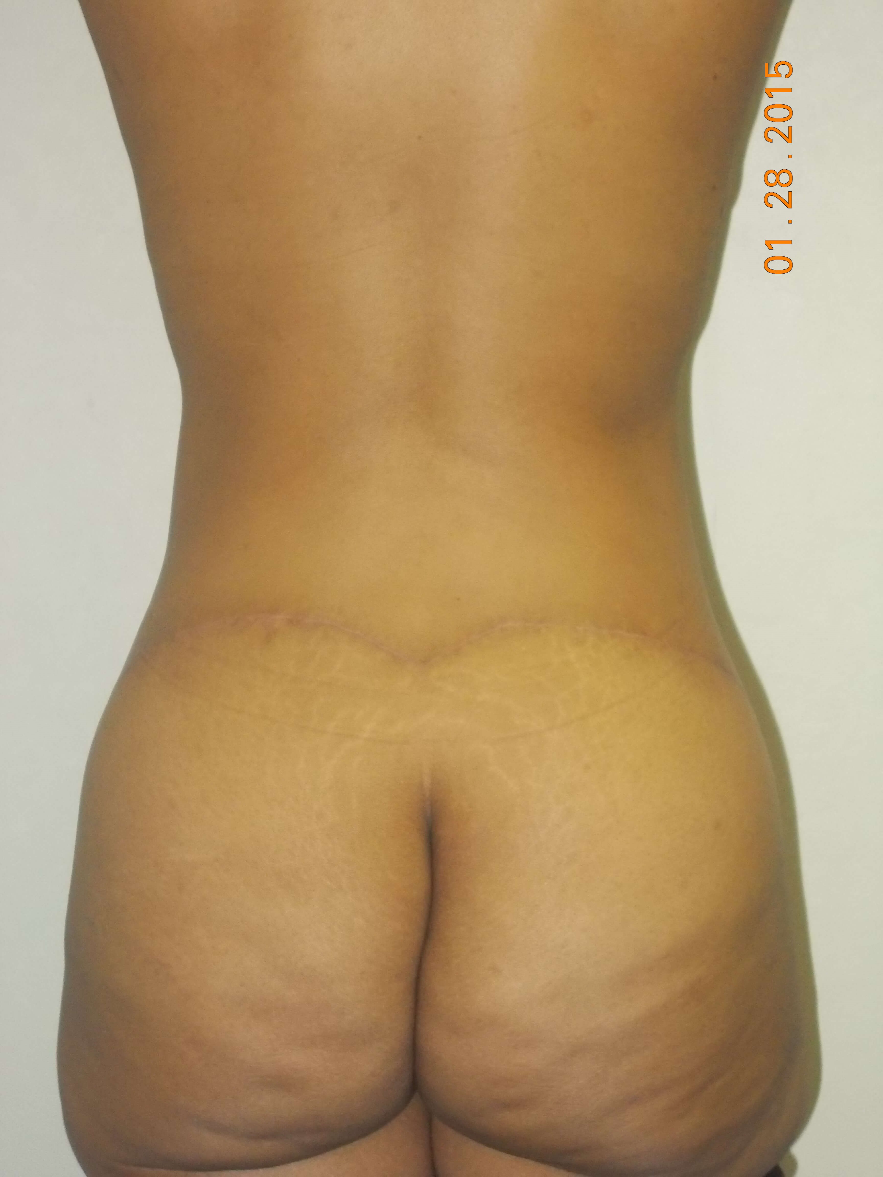 Back View After