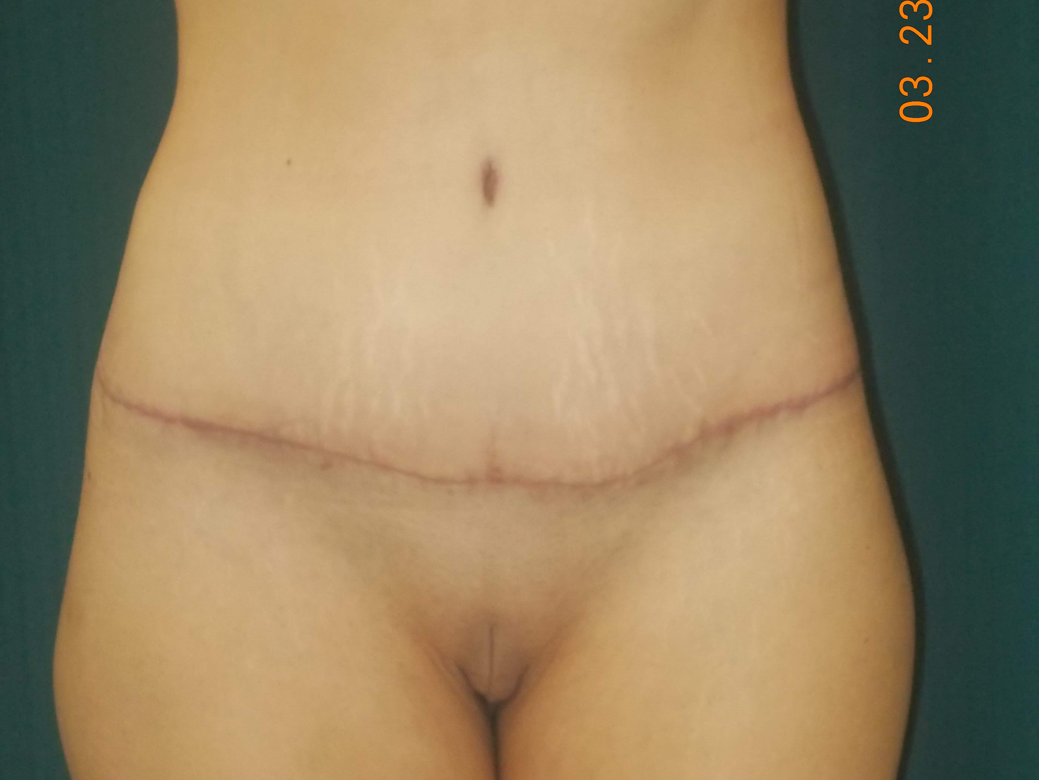 Front After
