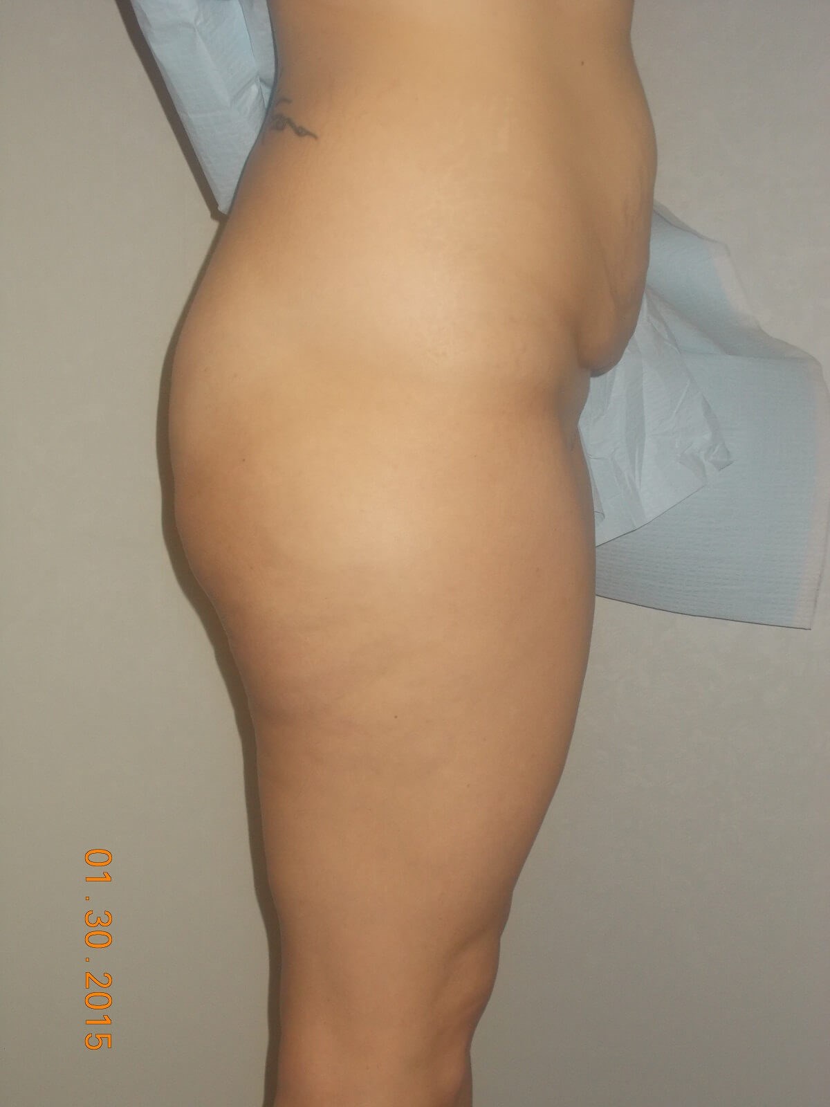 Side View Before