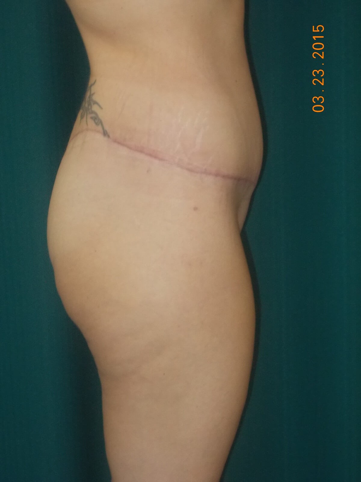 Side View After