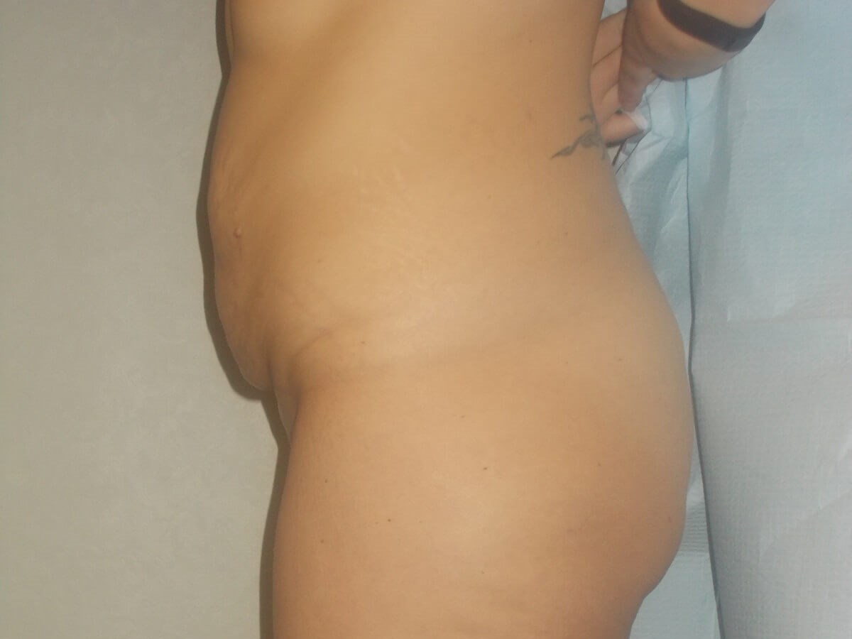 Side View Before