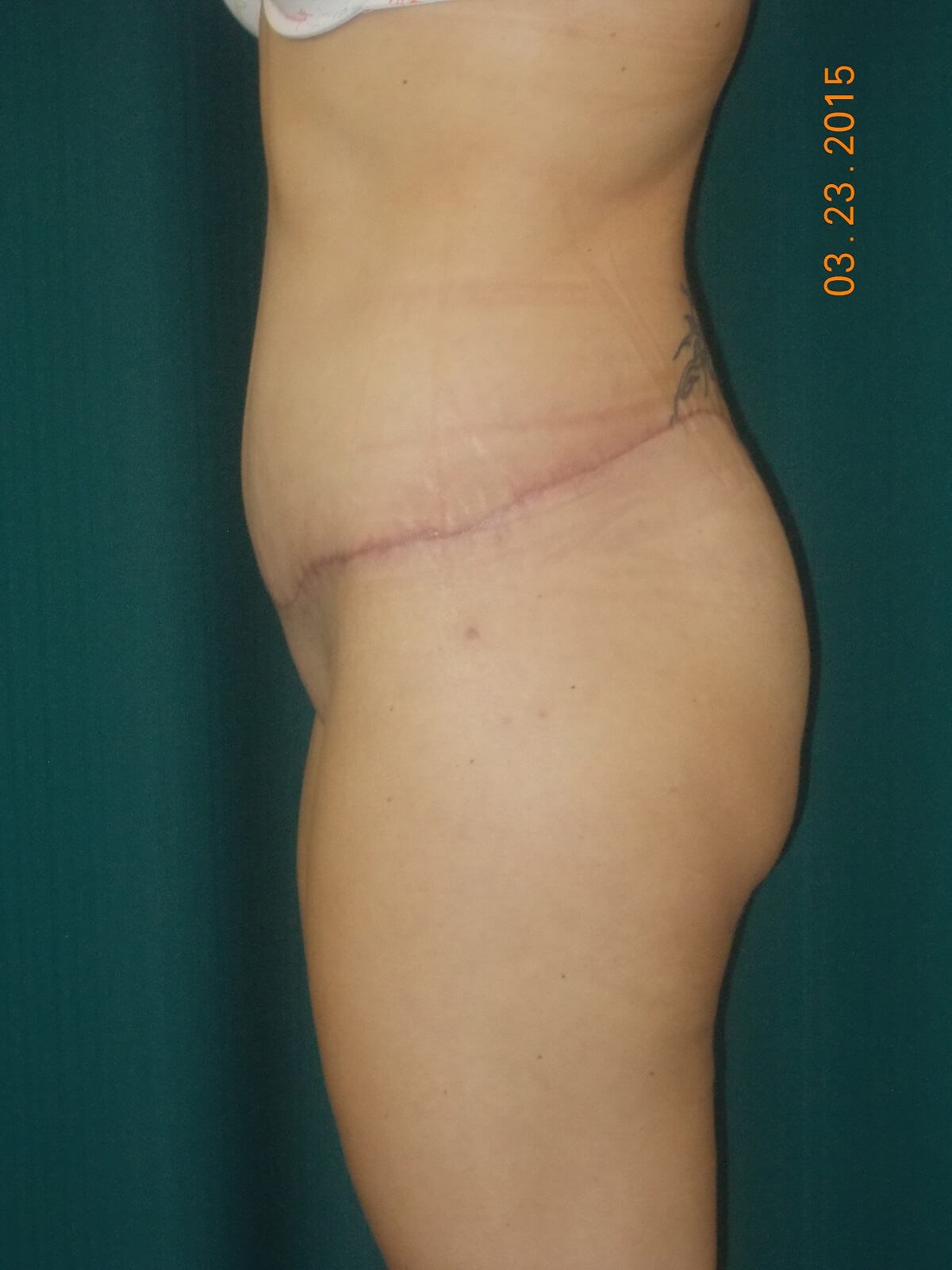 Side View After
