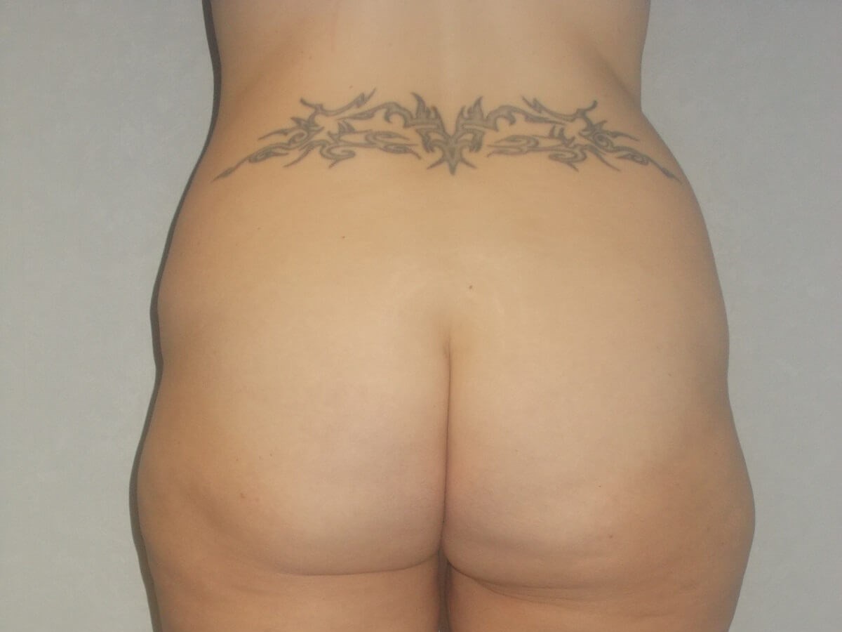 Back View Before