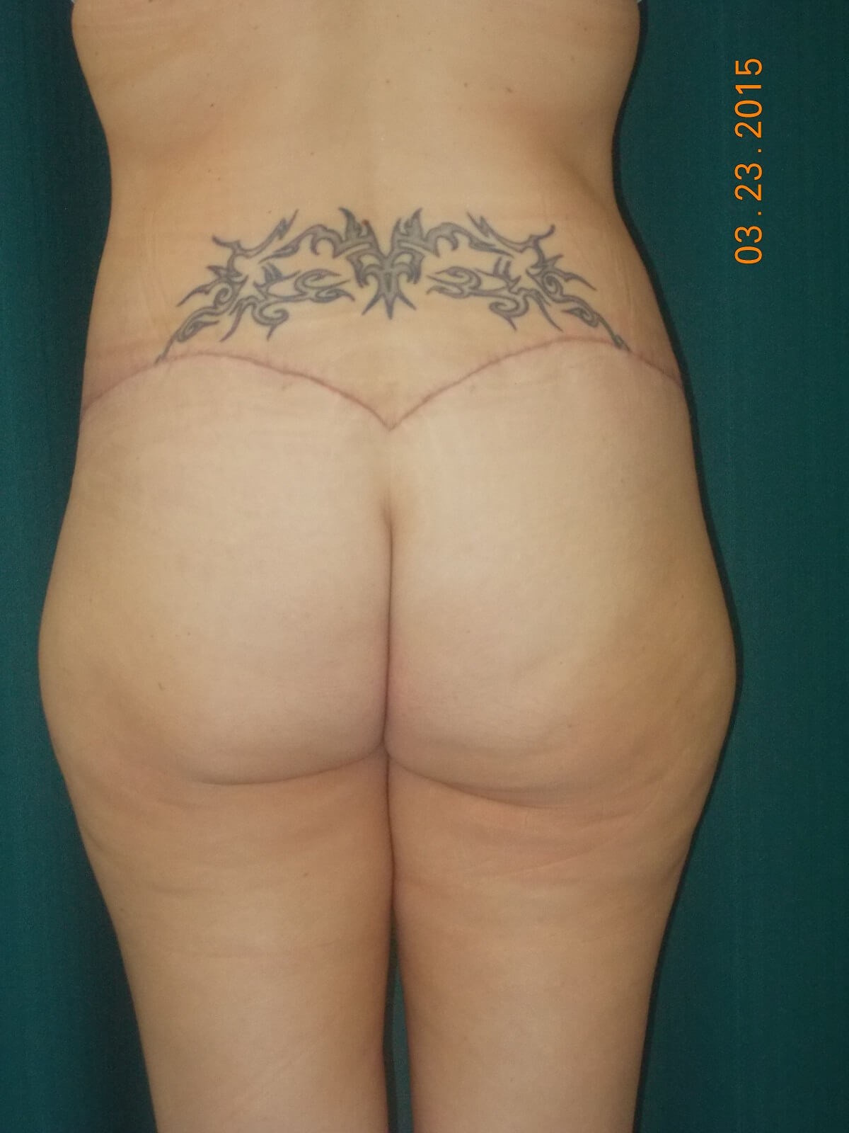 Back View After