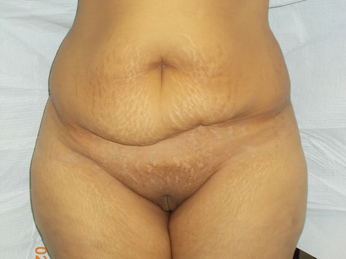 Front View Before
