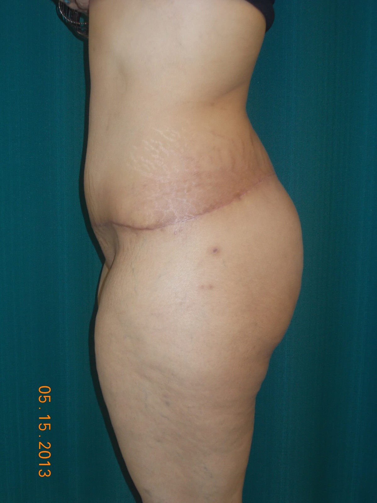 Side View After