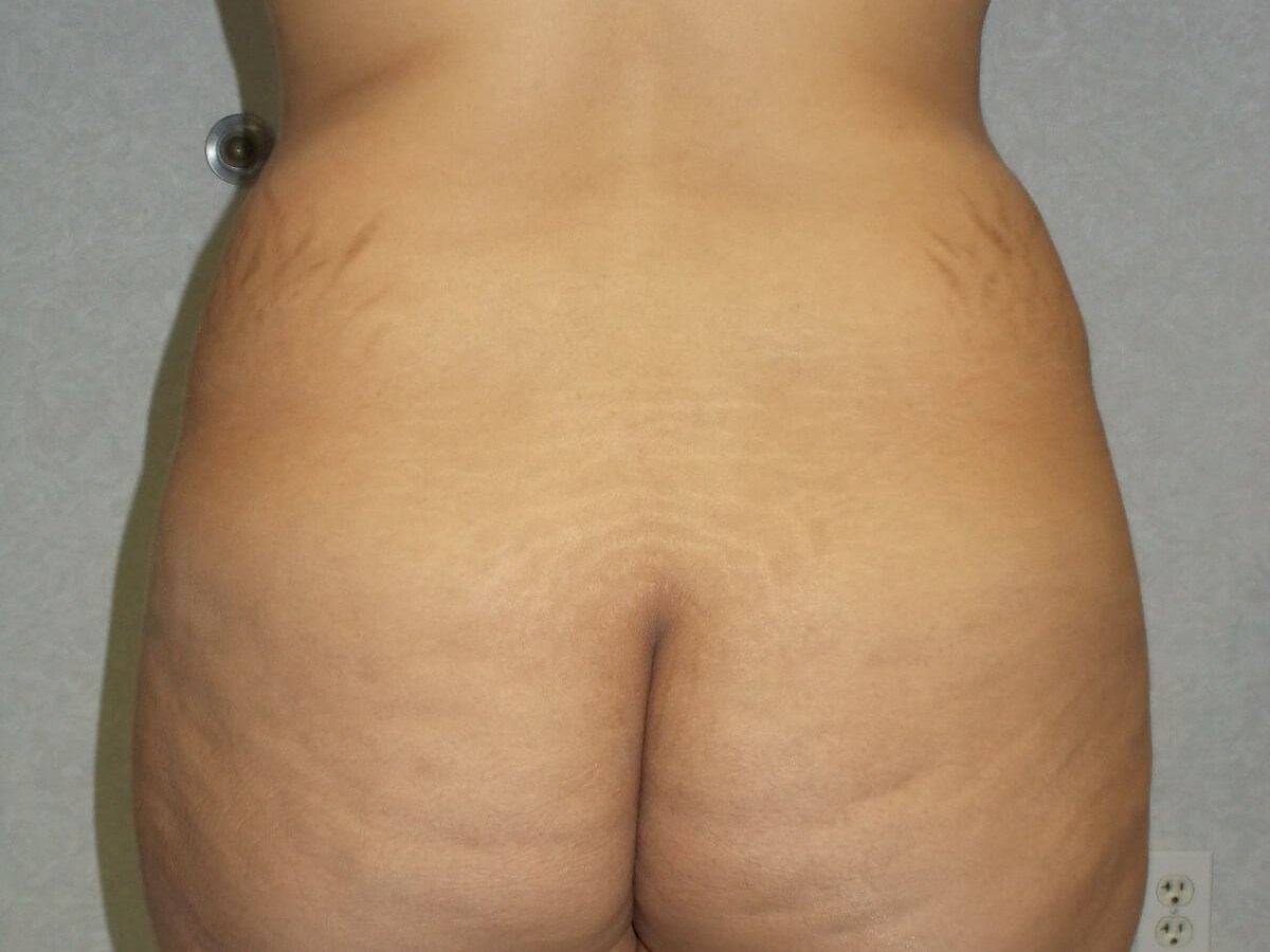 Back View Before