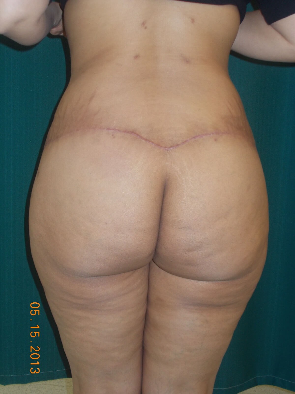 Back View After