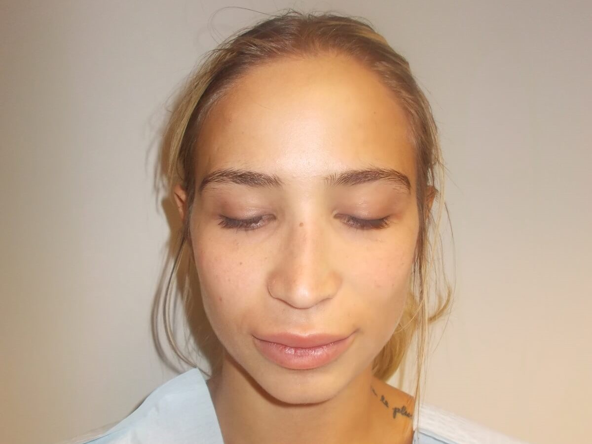 Front View After
