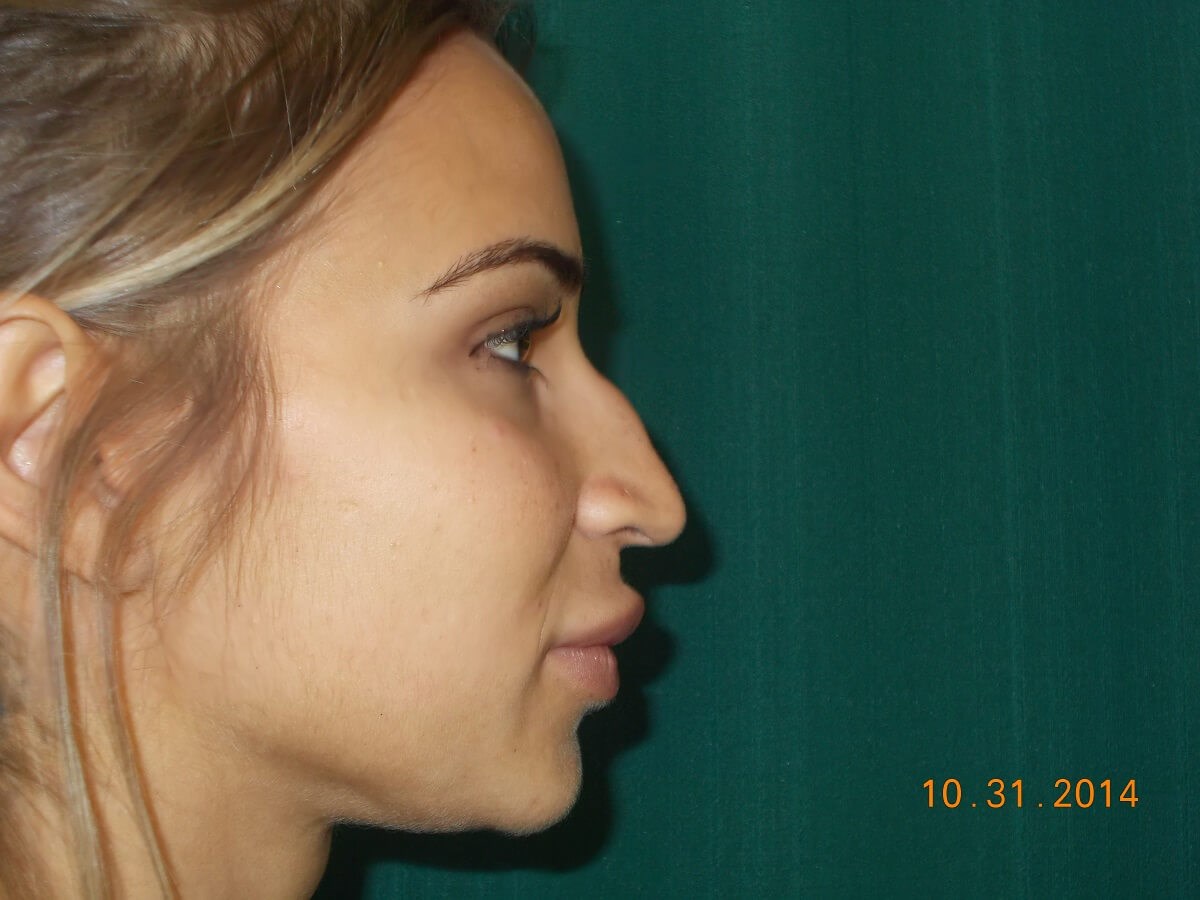Side View Before