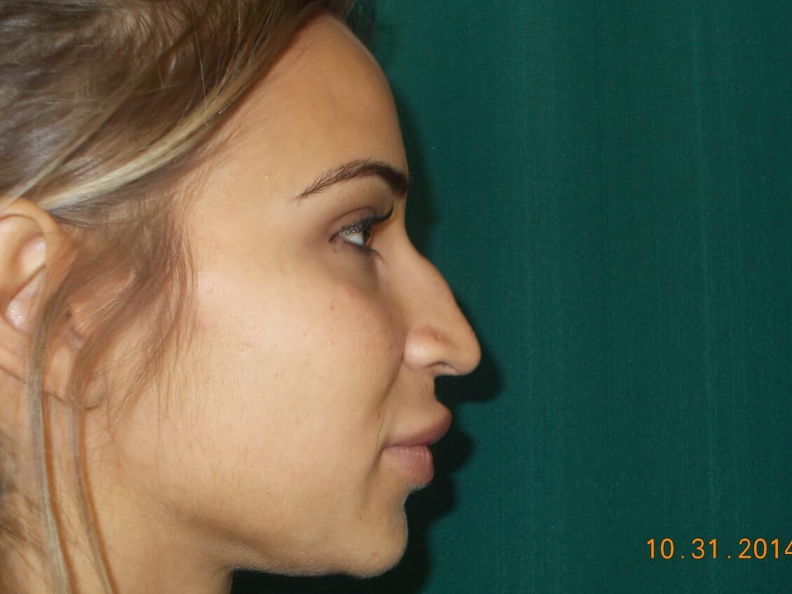 Side View Before
