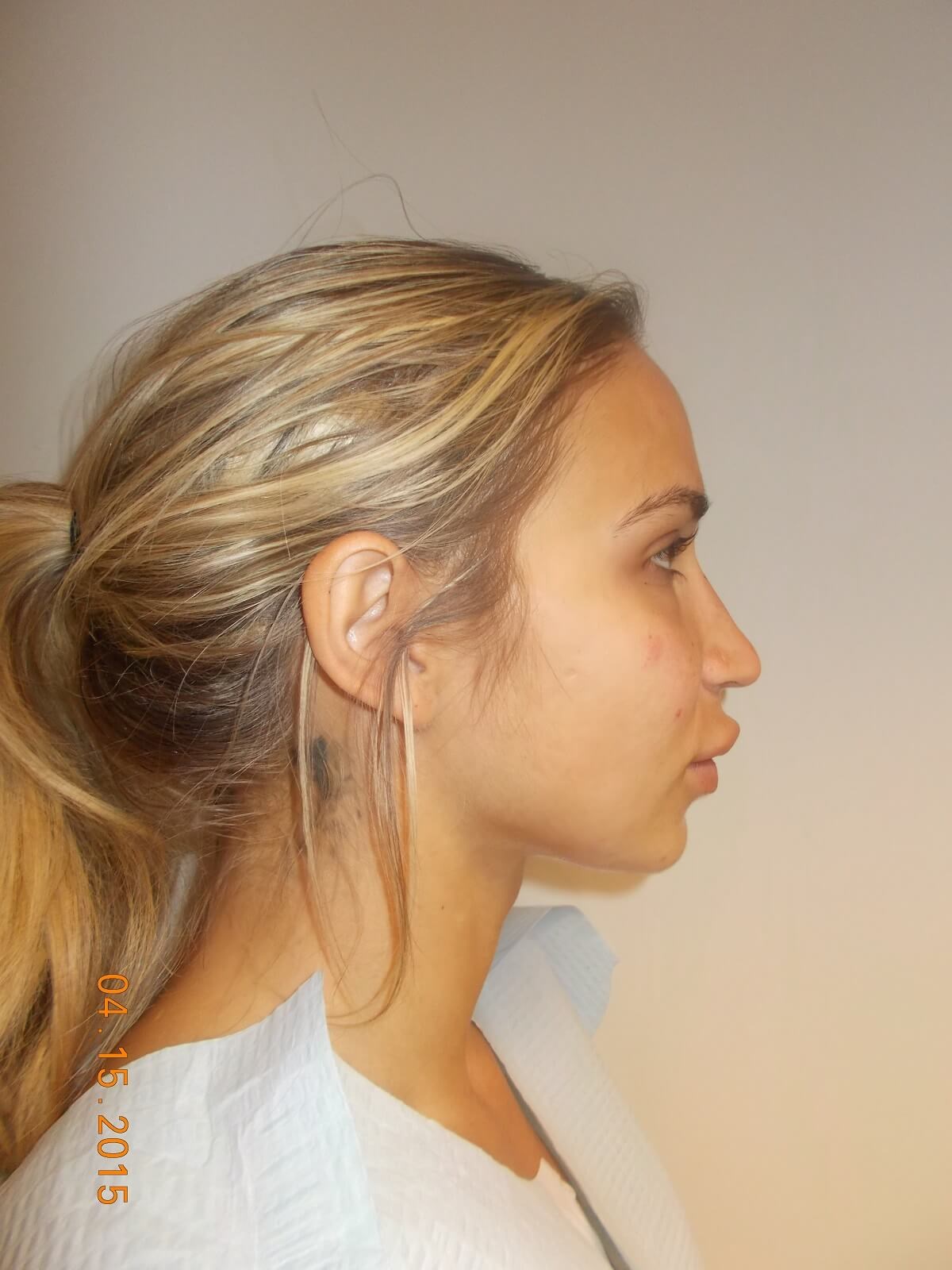 Side View After