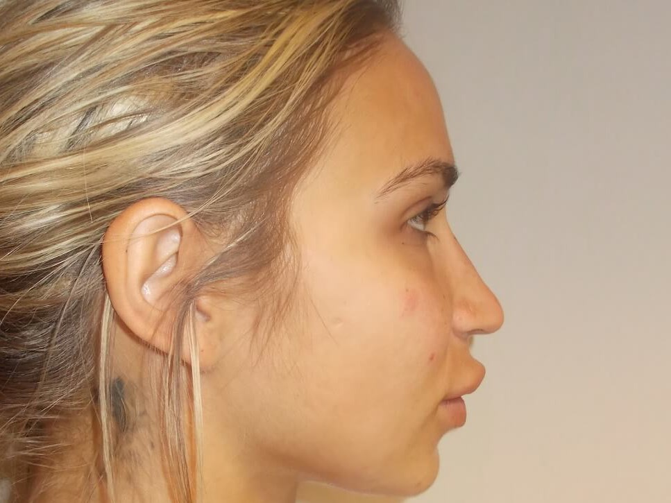 Side View After