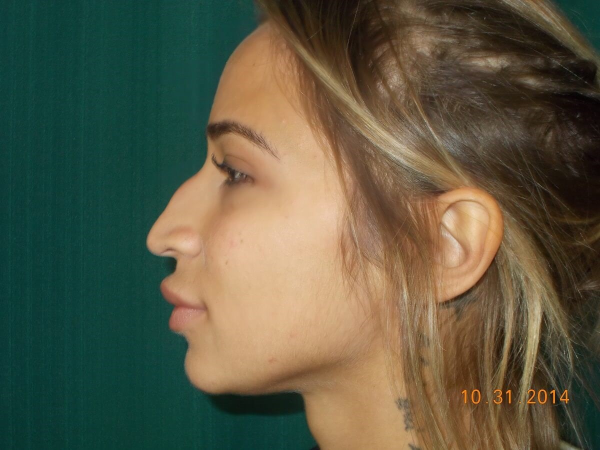 Side View Before