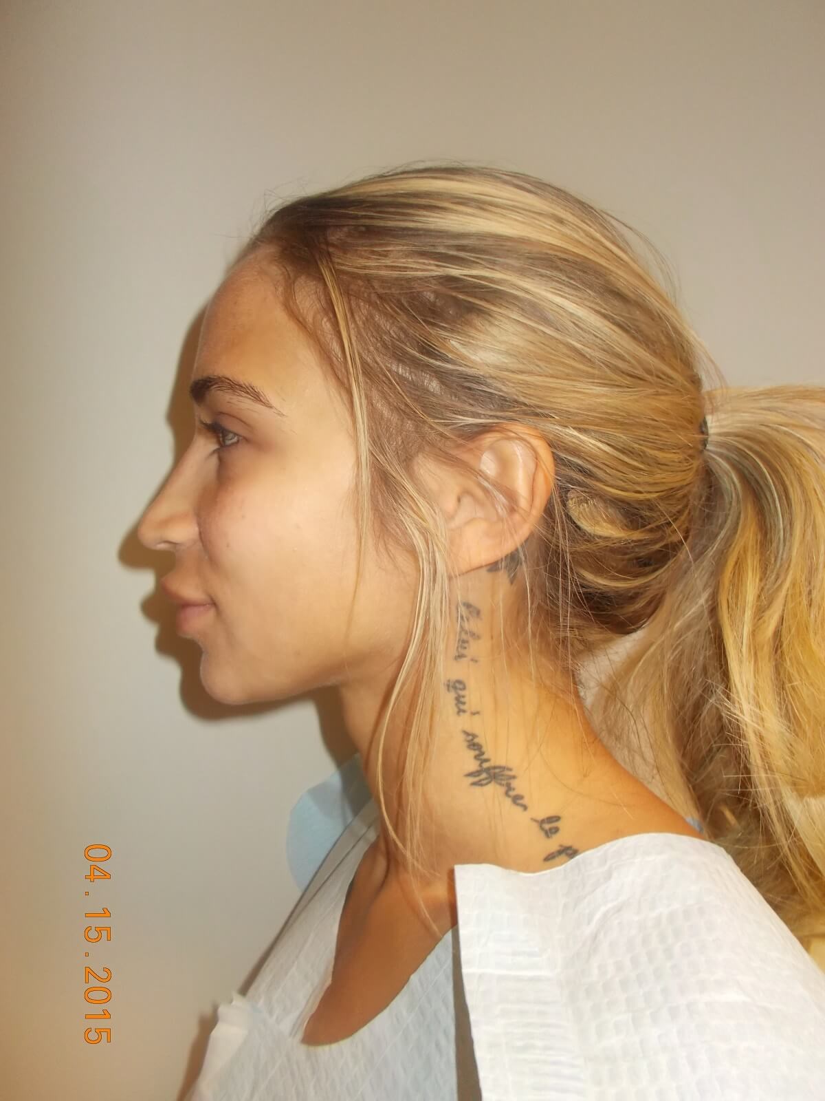 Side View After