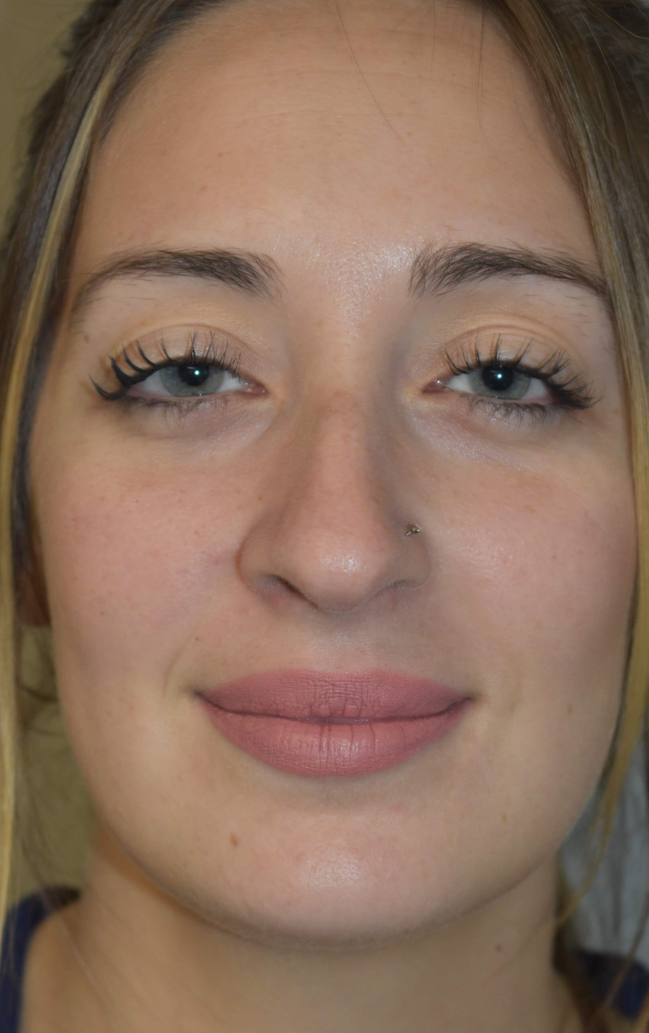 Rhinoplasty form and function Before