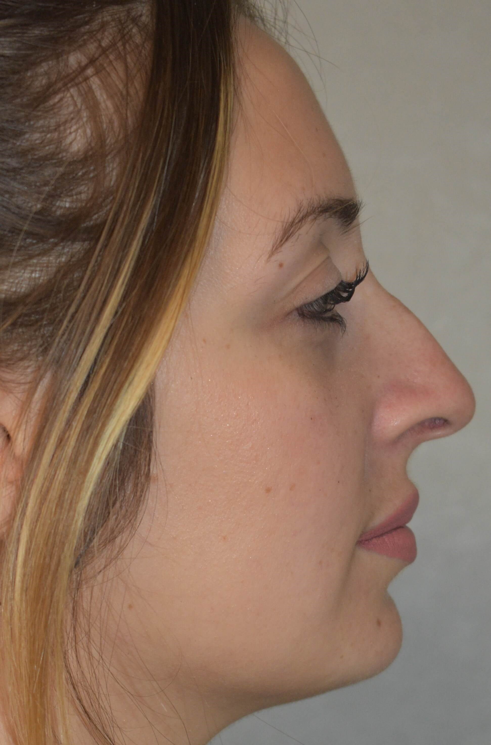 Reduction of dorsum Before
