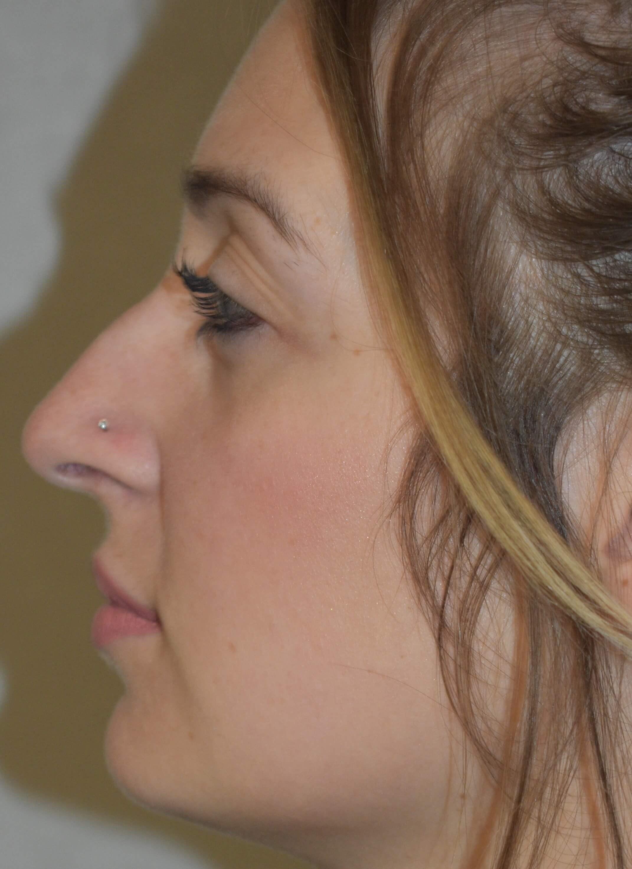 Facial  Symmetry Before