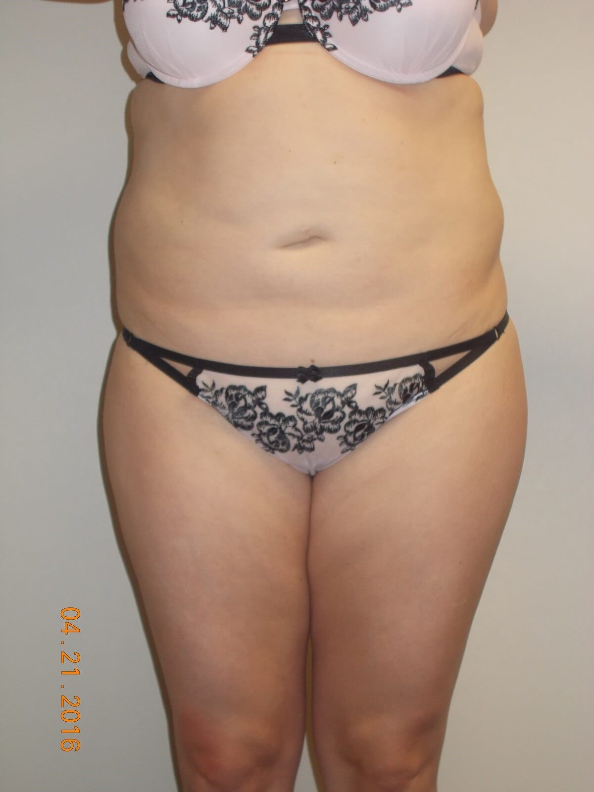 Front View Before