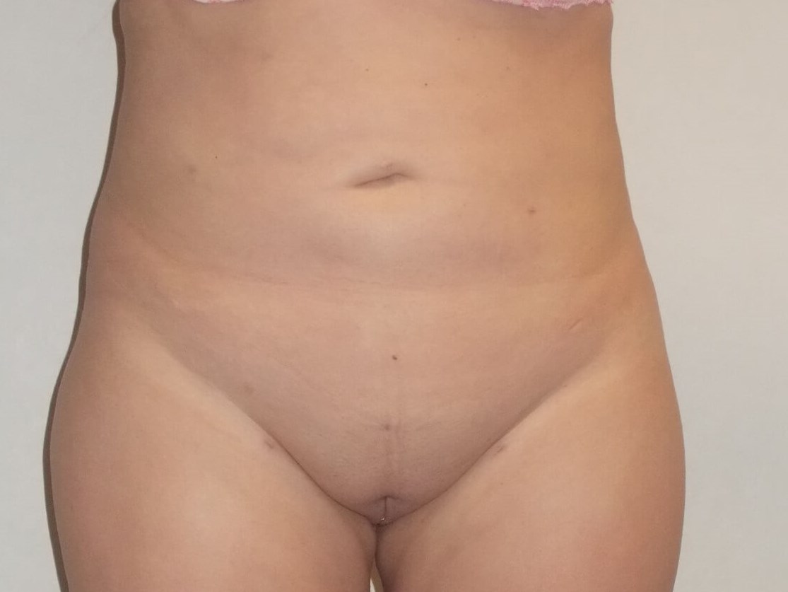 Front View After
