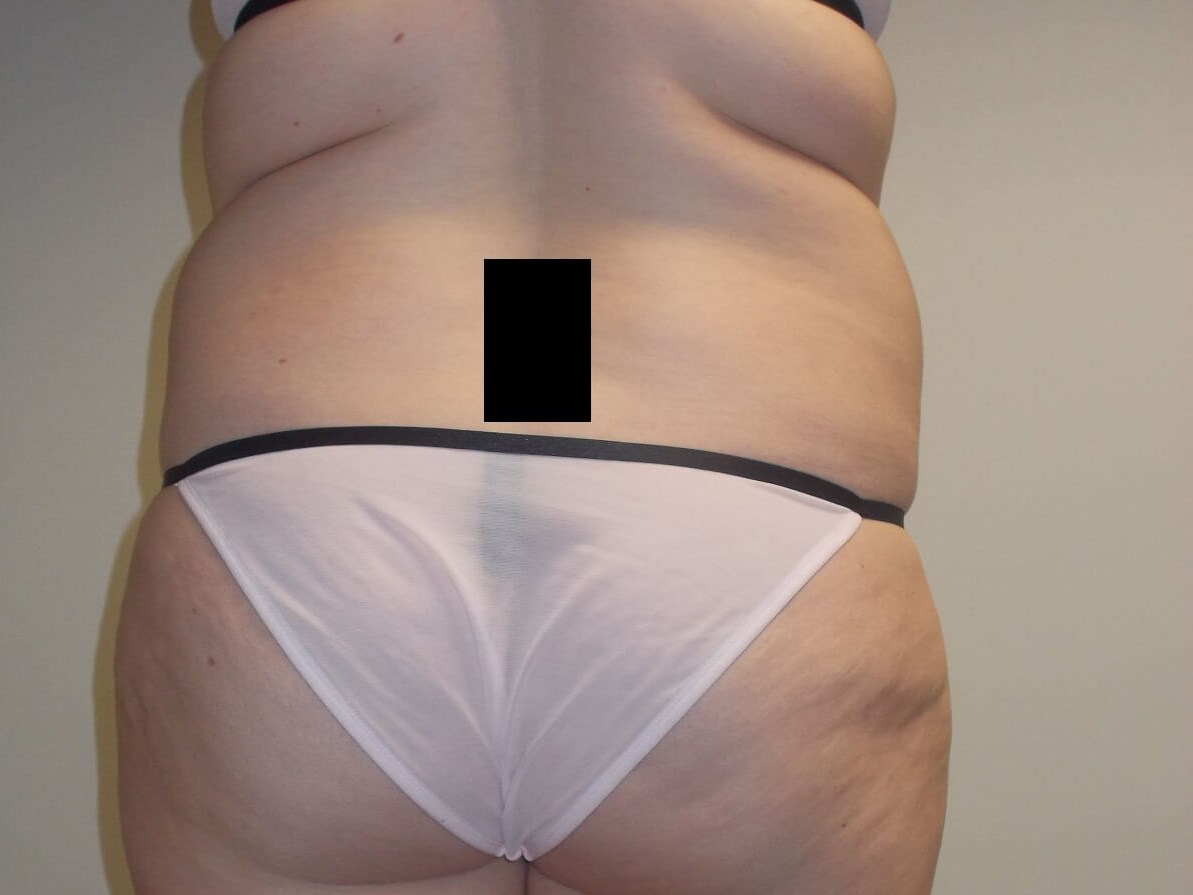 Back View Before