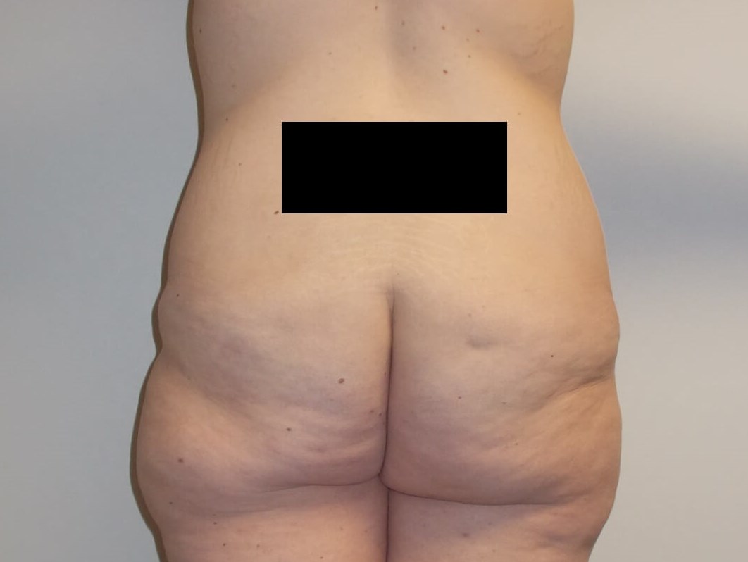 Back View Before