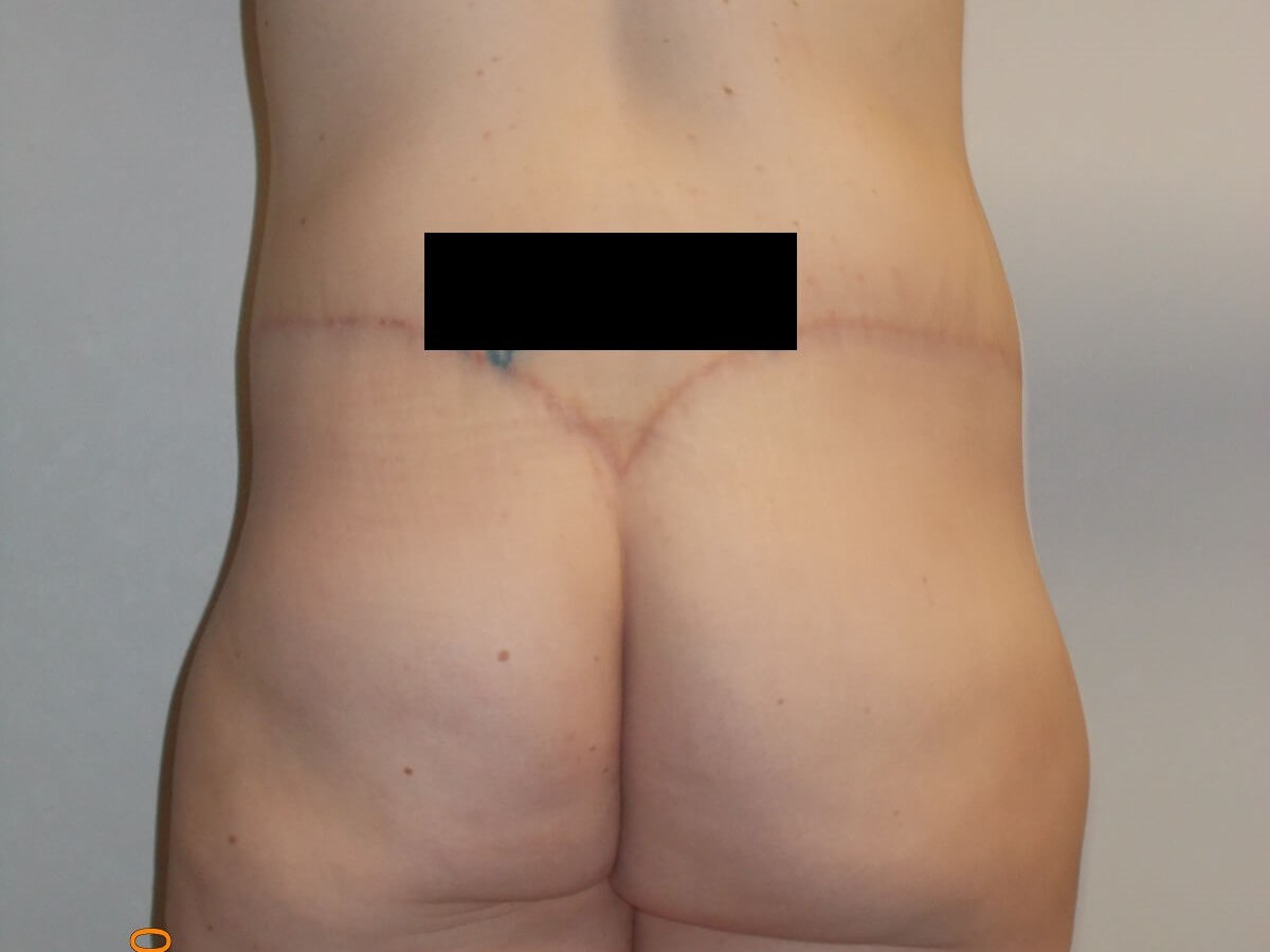 Back View After