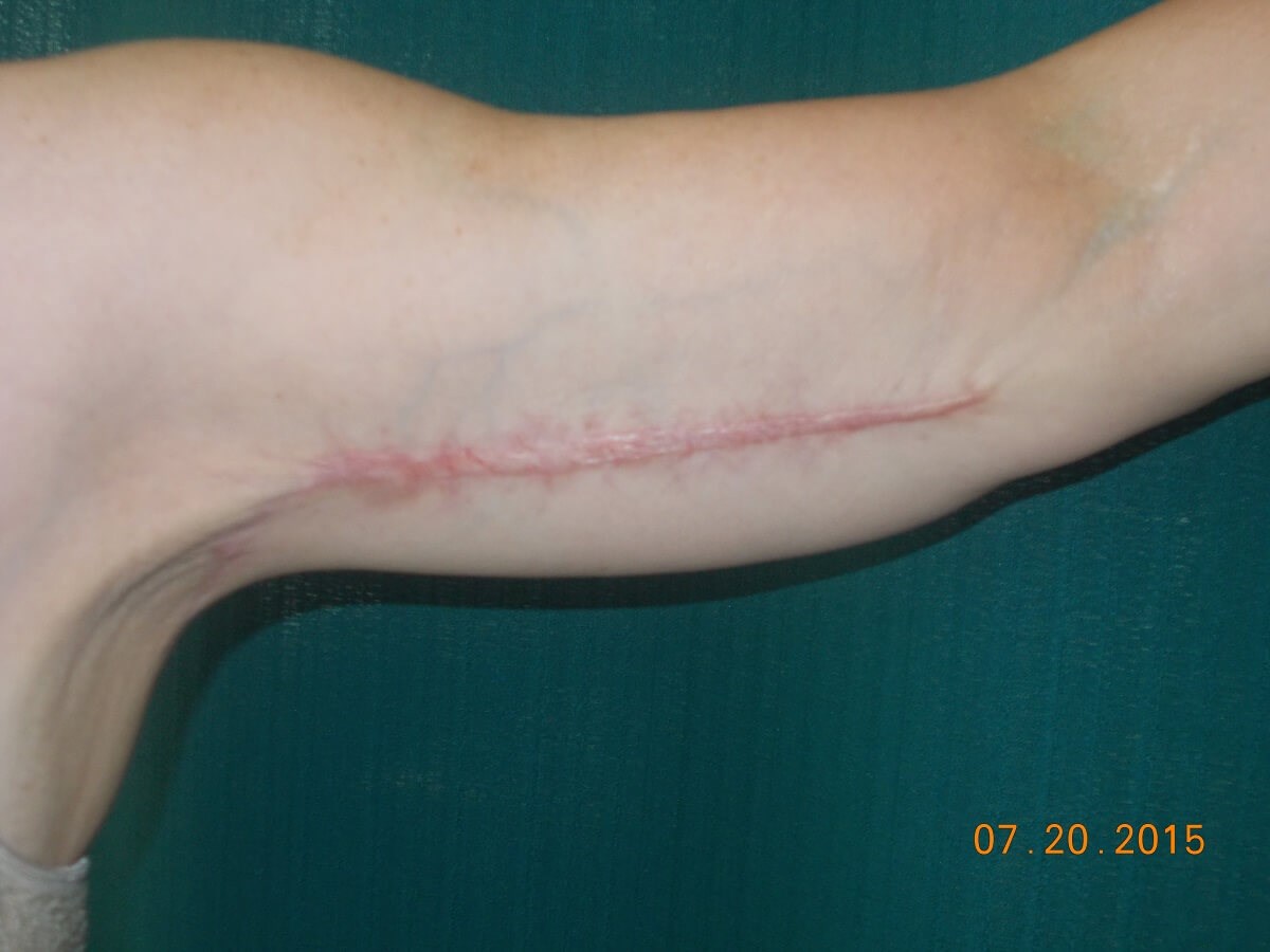 Front Before Scar Revision Surgery
