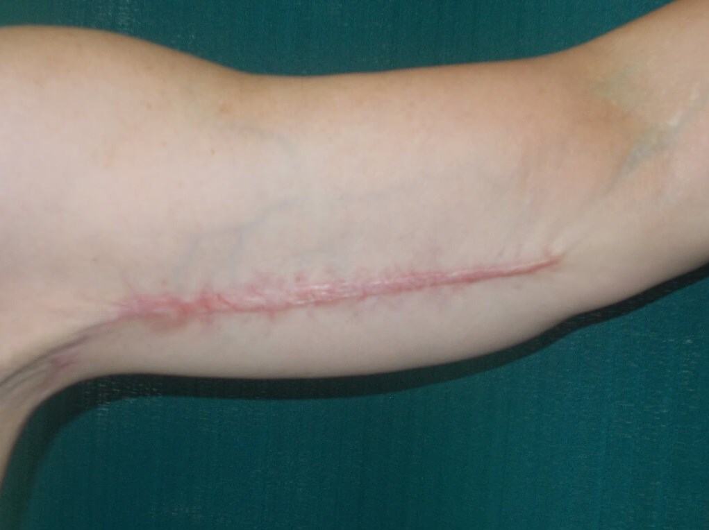 Front Before Scar Revision Surgery