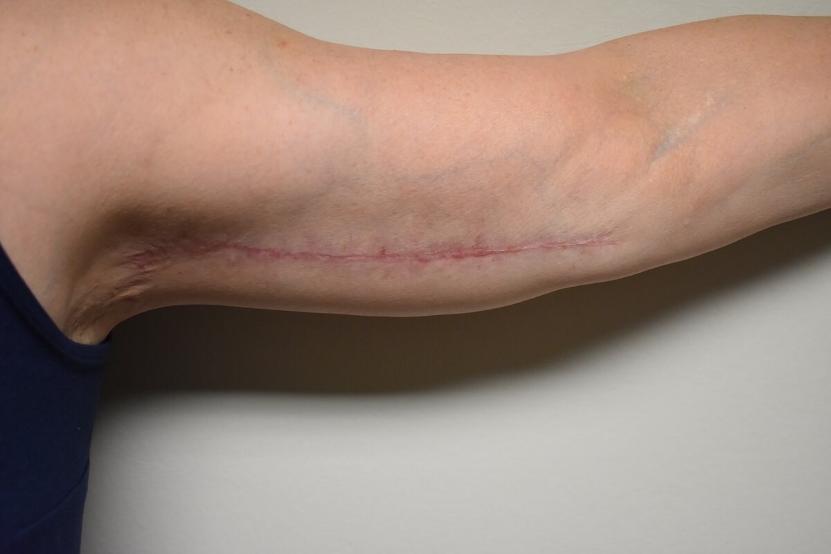 Front 6 Months After Surgery