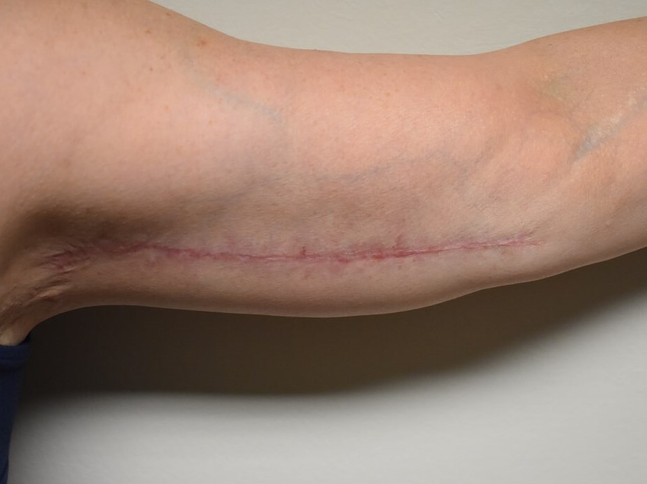 Front 6 Months After Surgery