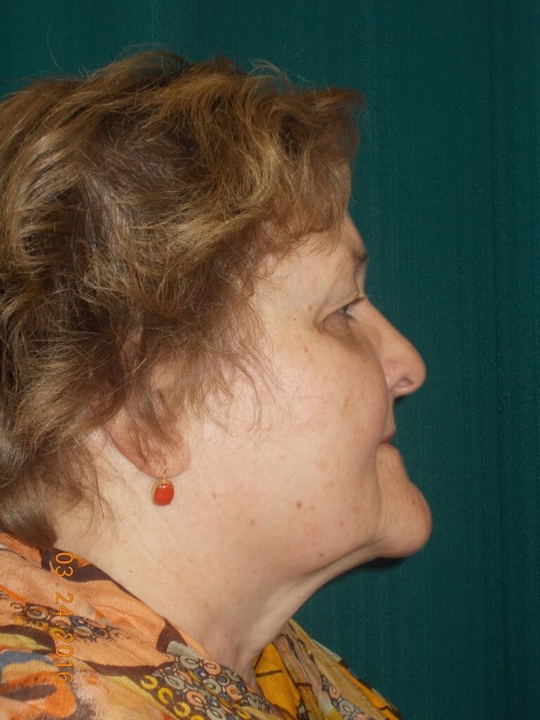 Side Before